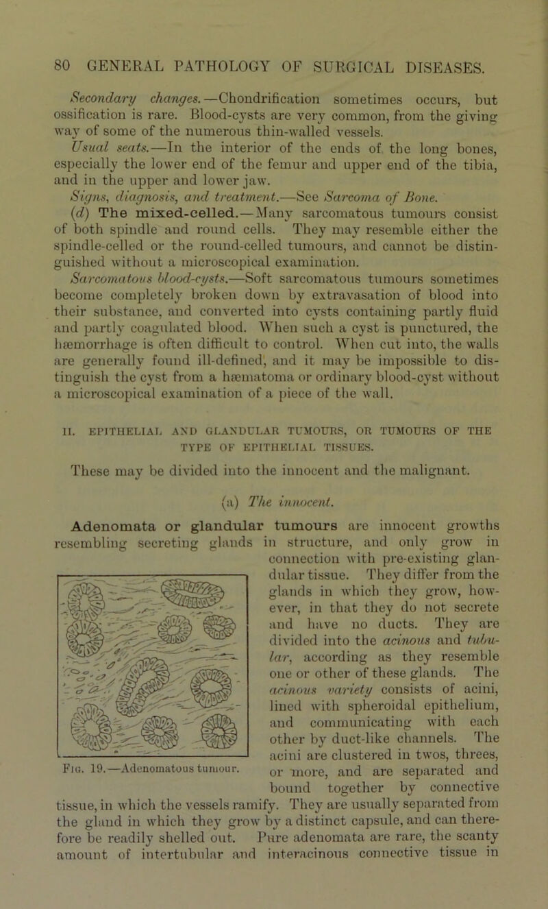 Secondary changes.—Chondrification sometimes occurs, but ossification is rare. Blood-cysts are very common, from the giving way of some of the numerous thin-walled vessels. Usual seats.—In the interior of the ends of the long bones, especially the lower end of the femur and upper end of the tibia, and in the upper and lower jaw. Signs, diagnosis, and treatment.—See Sarcoma of Bone. (d) The mixed-celled.—Many sarcomatous tumours consist of both spindle and round cells. They may resemble either the spindle-celled or the round-celled tumours, and cannot be distin- guished without a microscopical examination. Sarcomatous hloocl-cysts.—Soft sarcomatous tumours sometimes become completely broken down by extravasation of blood into their substance, and converted into cysts containing partly fluid and partly coagulated blood. When such a cyst is punctured, the haemorrhage is often difficult to control. When cut into, the walls are generally found ill-defined, and it may be impossible to dis- tinguish the cyst from a hsematoma or ordinary blood-cyst without a microscopical examination of a piece of the wall. 11. EPITHELIAL AND GLANDULAR TUMOURS, OR TUMOURS OF THE TYPE OF EPITHELIAL TISSUES. These may be divided into the innocent and the malignant. (a) The innocent. Adenomata or glandular tumours are innocent growths resembling secreting glands in structure, and only grow in connection with pre-existing glan- dular tissue. They differ from the glands in which they grow, how- ever, in that they do not secrete and have no ducts. They are divided into the acinous and tubu- lar, according as they resemble one or other of these glands. The acinous variety consists of acini, lined with spheroidal epithelium, and communicating with each other by duct-like channels. The acini are clustered in twos, threes, or more, and are separated and bound together by connective tissue, in which the vessels ramify. They are usually separated from the gland in which they grow by a distinct capsule, and can there- fore be readily shelled out. Pure adenomata are rare, the scanty amount of intertubular and interacinous connective tissue in Fid. 19.—Adonouiatous tumour.