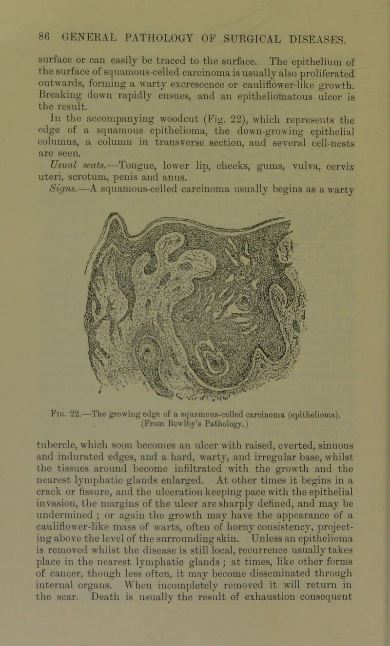 surface or cau easily be traced to the surface. The epithelium of the surface of squamous-celled carcinoma is usually also proliferated outwards, forming a warty excrescence or cauliflower-like growth. Breaking down rapidly ensues, and an epitheliomatous ulcer is the result. In the accompanying woodcut (Fig. 22), which represents the edge of a squamous epithelioma, the down-growing epithelial columns, a column in transverse section, and several cell-nests are seen. Usual seats.—Tongue, lower lip, cheeks, gums, vulva, cervix uteri, scrotum, penis and anus. Signs.—A squamous-celled carcinoma usually begins as a warty Flo. 22.—The growing edge of a squamous-celled carcinoma (epithelioma). (From Bowlby’s Pathology.) tubercle, which soon becomes an ulcer with raised, everted, sinuous and indurated edges, aud a hard, warty, and irregular base, whilst the tissues around become infiltrated with the growth and the nearest lymphatic glands enlarged. At other times it begins in a crack or fissure, and the ulceration keeping pace with the epithelial invasion, the margins of the ulcer are sharply defined, and may be undermined ; or again the growth may have the appearance of a cauliflower-like mass of warts, often of horny consistency, project- ing above the level of the surrounding skin. Unless an epithelioma is removed whilst the disease is still local, recurrence usually takes place in the nearest lymphatic glands ; at times, like other forms of cancer, though less often, it may become disseminated through internal organs. When incompletely removed it will return in the scar. Death is usually the result of exhaustion consequent