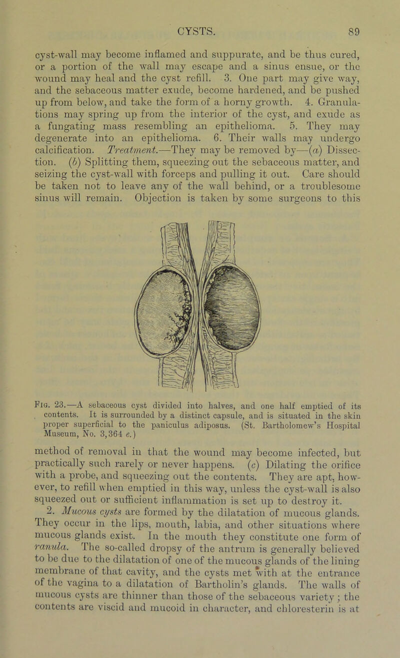 cyst-wall may become inflamed and suppurate, and be thus cured, or a portion of the wall may escape and a sinus ensue, or the wound may heal and the cyst refill. 3. One part may give way, and the sebaceous matter exude, become hardened, and be pushed up from below, and take the form of a horny growth. 4. Granula- tions may spring up from the interior of the cyst, and exude as a fungating mass resembling an epithelioma. 5. They may degenerate into an epithelioma. 6. Their walls may undergo calcification. Treatment.—They may be removed by—(a) Dissec- tion. (J>) Splitting them, squeezing out the sebaceous matter, and seizing the cyst-wall with forceps and pulling it out. Care should be taken not to leave any of the wall behind, or a troublesome sinus will remain. Objection is taken by some surgeons to this Fig. 23.—A sebaceous cyst divided into halves, and one half emptied of its contents. It is surrounded by a distinct capsule, and is situated in the skin proper superficial to the paniculus adiposus. (St. Bartholomew’s Hospital Museum, No. 3,364 e.) method of removal in that the wound may become infected, but practically such rarely or never happens, (c) Dilating the orifice with a probe, and squeezing out the contents. They are apt, how- ever, to refill when emptied in this way, unless the cyst-wall is also squeezed out or sufficient inflammation is set up to destroy it. 2. Mucous cysts are formed by the dilatation of mucous glands. Ihey occur in the lips, mouth, labia, and other situations where mucous glands exist. In the mouth they constitute one form of ranula. The so-called dropsy of the antrum is generally believed to be due to the dilatation of one of the mucous glands of the lining membrane of that cavity, and the cysts met with at the entrance of the vagina to a dilatation of Bartholin’s glands. The walls of mucous cysts are thinner than those of the sebaceous variety ; the contents are viscid and mucoid in character, and chloresterin is at