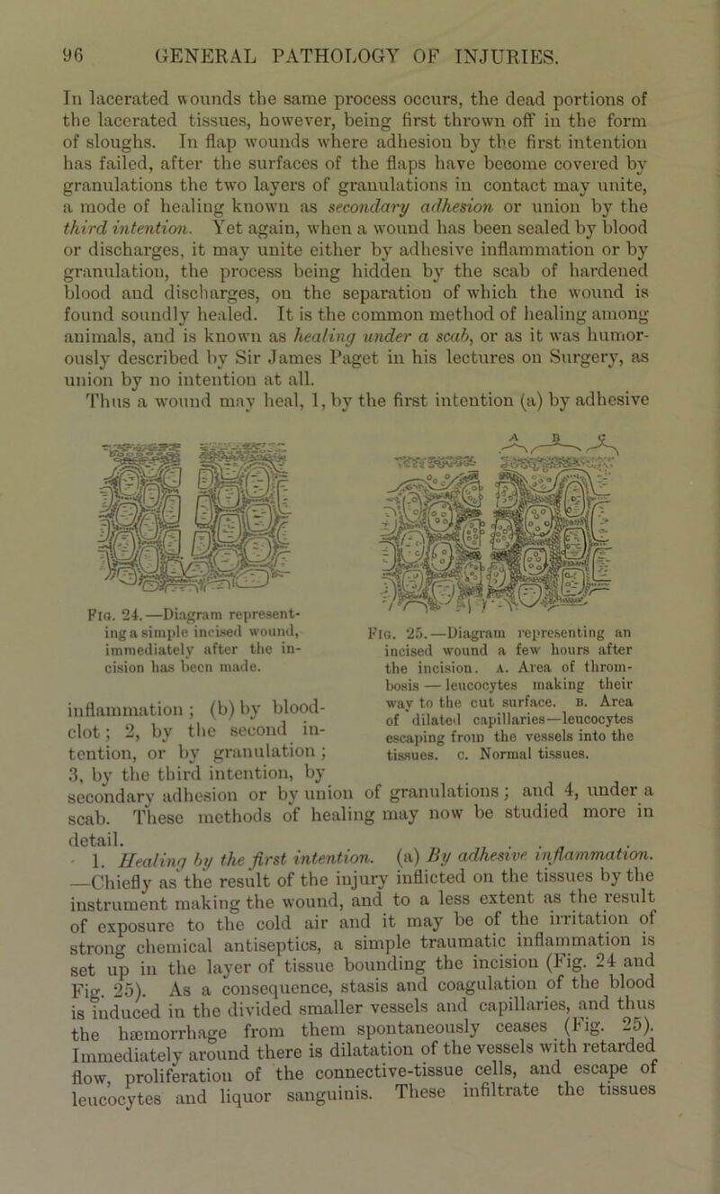 In lacerated wounds the same process occurs, the dead portions of the lacerated tissues, however, being first thrown off in the form of sloughs. In flap wounds where adhesion by the first intention lias failed, after the surfaces of the flaps have become covered by granulations the two layers of granulations in contact may unite, a mode of healing known as secondary adhesion or union by the third intention. Yet again, when a wound has been sealed by blood or discharges, it may unite either by adhesive inflammation or by granulation, the process being hidden by the scab of hardened blood and discharges, on the separation of which the wound is found soundly healed. It is the common method of healing among animals, and is known as healing under a scab, or as it was humor- ously described by Sir James Paget in his lectures on Surgery, as union by no intention at all. Thus a wound may heal, 1, by the first intention (a) by adhesive Flo. 24.—Diagram represent- ing a simple incised wound, immediately after the in- cision lias been made. Flo. 25.—Diagram representing an incised wound a few hours after the incision, a. Area of throm- bosis — leucocytes making their way to the cut surface, b. Area of dilated capillaries—leucocytes escaping from the vessels into the tissues, c. Normal tissues. inflammation; (b) by blood- clot ; 2, by the second in- tention, or by granulation; 3, by the third intention, by secondary adhesion or by union of granulations , and 4, under a scab. These methods of healing may now be studied more in detail. 1. Healing by the first intention, (a) By adhesive, inflammation. Chiefly as' the result of the injury inflicted on the tissues by the instrument making the wound, and to a less extent as the lesult of exposure to the cold air and it may be of the iiritation of stroll0- chemical antiseptics, a simple traumatic inflammation is set up in the layer of tissue bounding the incision (Fig. 24 and Fig. 25). As a consequence, stasis and coagulation of the blood is Tuduced in the divided smaller vessels and capillaries, and thus the haemorrhage from them spontaneously ceases (big. _5). Immediately around there is dilatation of the vessels with retarded flow proliferation of the connective-tissue cells, and escape of leucocytes and liquor sanguinis. These infiltrate the tissues