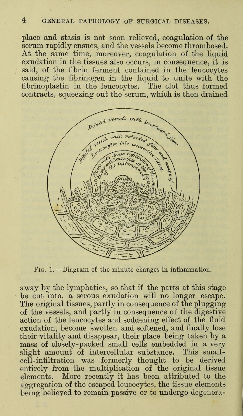 place and stasis is not soon relieved, coagulation of the serum rapidly ensues, and the vessels become thrombosed. At the same time, moreover, coagulation of the liquid exudation in the tissues also occurs, in consequence, it is said, of the fibrin ferment contained in the leucocytes causing the fibrinogen in the liquid to unite with the fibrinoplastin in the leucocytes. The clot thas formed contracts, squeezing out the serum, which is then drained Fig. 1.—Diagram of the minute changes in inflammation. away by the lymphatics, so that if the parts at this stage be cut into, a serous exudation will no longer escape. The original tissues, partly in consequence of the plugging of the vessels, and partly in consequence of the digestive action of the leucocytes and soddening effect of the fluid exudation, become swollen and softened, and finally lose their vitality and disappear, their place being taken by a mass of closely-packed small cells embedded in a very slight amount of intercellular substance. This small- cell-infiltration was formerly thought to be derived entirely from the multiplication of the original tissue elements. More recently it has been attributed to the aggregation of the escaped leucocytes, the tissue elements being believed to remain passive or to undergo degcnera-