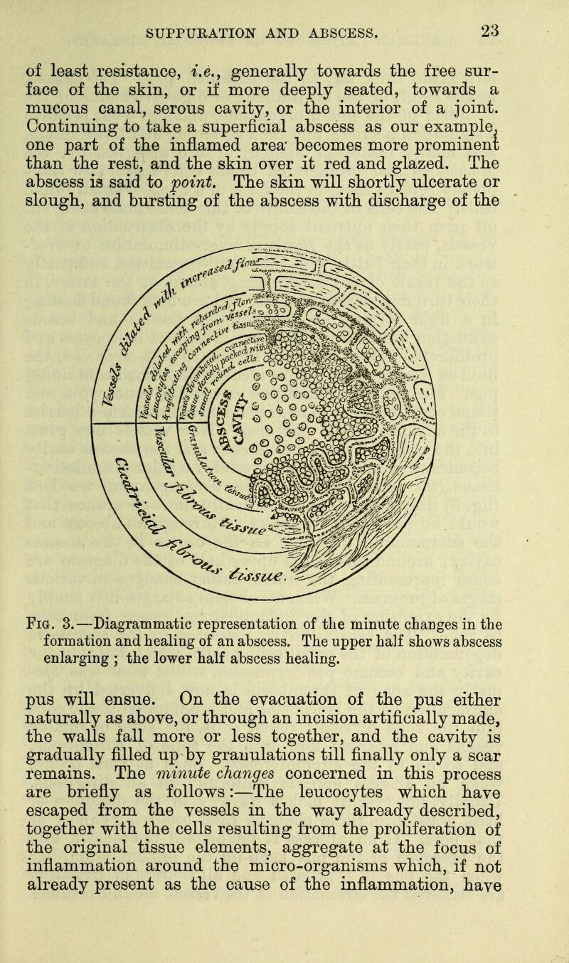 of least resistance, i.e., generally towards the free sur- face of the skin, or if more deeply seated, towards a mucous canal, serous cavity, or the interior of a joint. Continuing to take a superficial abscess as our example, one part of the inflamed area' becomes more prominent than the rest, and the skin over it red and glazed. The abscess is said to point. The skin will shortly ulcerate or slough, and bursting of the abscess with discharge of the Fig. 3.—Diagrammatic representation of the minute changes in the formation and heaHng of an abscess. The upper half shows abscess enlarging ; the lower half abscess healing. pus will ensue. On the evacuation of the pus either naturally as above, or through an incision artificially made, the walls fall more or less together, and the cavity is gradually filled up by granulations till finally only a scar remains. The minute changes concerned in this process are briefly as follows:—The leucocytes which have escaped from the vessels in the way already described, together with the cells resulting from the proliferation of the original tissue elements, aggregate at the focus of inflammation around the micro-organisms which, if not already present as the cause of the inflammation, have