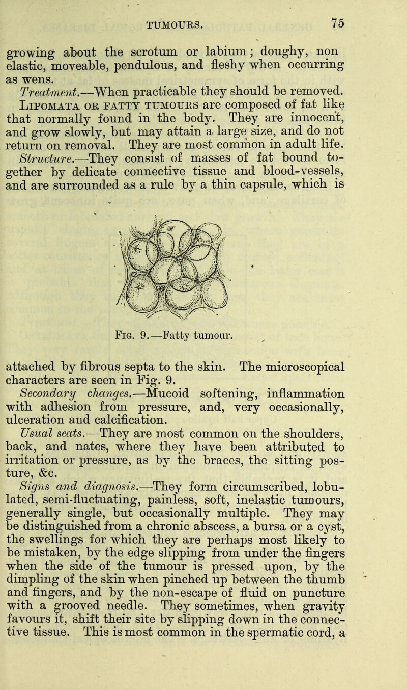 growing about the scrotum or labium; doughy, non elastic, moveable, pendulous, and fleshy when occurring as wens. Treatment.—When practicable they should be removed. LiPOMATA OR FATTY TUMOURS are composed of fat like that normally found in the body. They are innocent, and grow slowly, but may attain a large size, and do not return on removal. They are most comnion in adult life. Structure,—They consist of masses of fat bound to- gether by delicate connective tissue and blood-vessels, and are surrounded as a rule by a thin capsule, which is Fia. 9.—Fatty tumour. attached by fibrous septa to the skin. The microscopical characters are seen in Fig. 9. Secondary changes.—Mucoid softening, inflammation with adhesion from pressure, and, very occasionally, ulceration and calcification. Usual seats.—They are most common on the shoulders, back, and nates, where they have been attributed to irritation or pressure, as by the braces, the sitting pos- ture, &c. Signs and diagnosis.—They form circumscribed, lobu- lated, semi-fluctuating, painless, soft, inelastic tumours, generally single, but occasionally multiple. They may be distinguished from a chronic abscess, a bursa or a cyst, the swellings for which they are perhaps most likely to be mistaken, by the edge slipping from under the fingers when the side of the tumour is pressed upon, by the dimpling of the skin when pinched up between the thumb and fingers, and by the non-escape of fluid on puncture with a grooved needle. They sometimes, when gravity favours it, shift their site by slipping down in the connec- tive tissue. This is most common in the spermatic cord, a