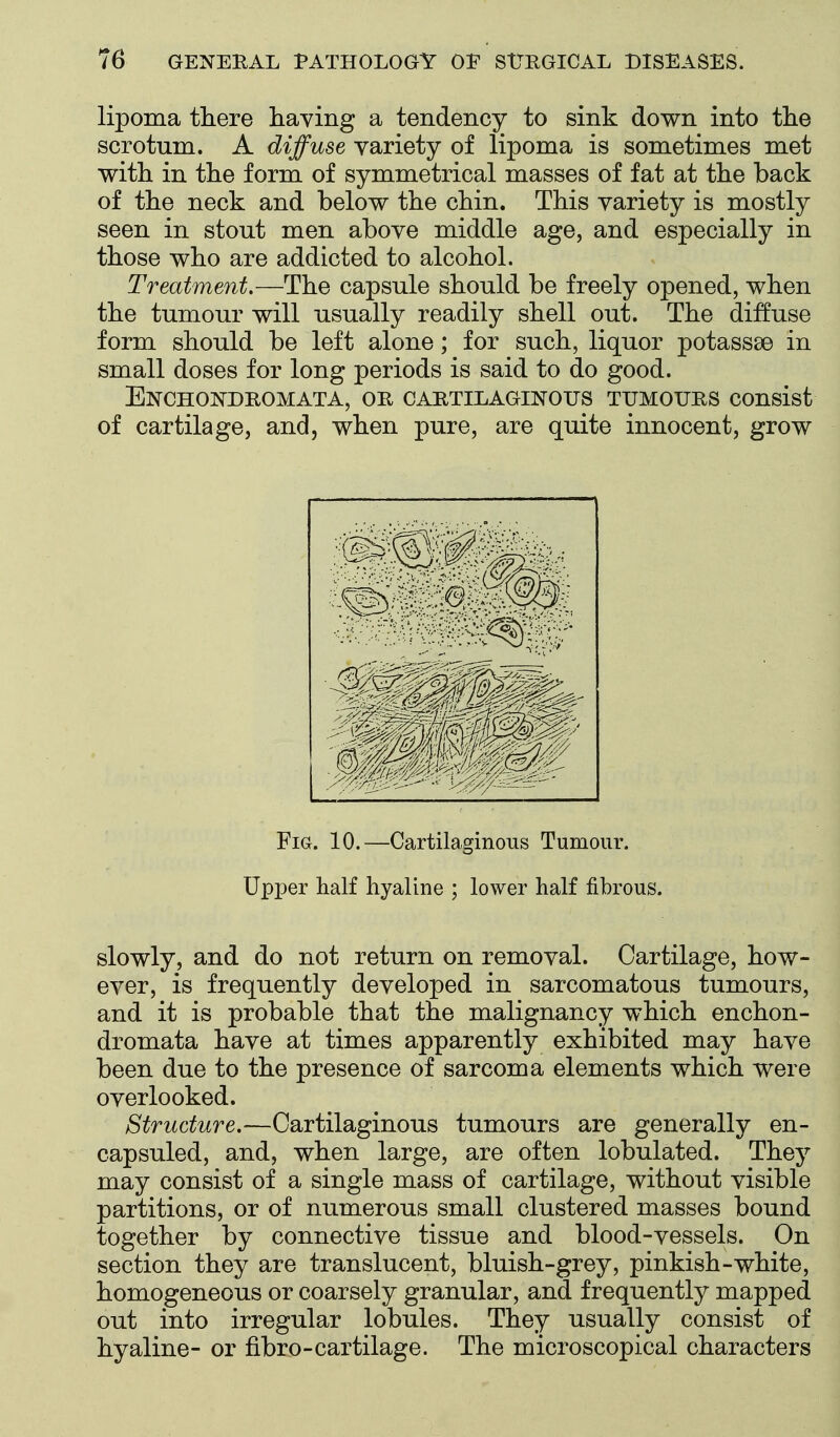 lipoma there having a tendency to sink down into the scrotum. A diffuse variety of lipoma is sometimes met with in the form of symmetrical masses of fat at the back of the neck and below the chin. This variety is mostly seen in stout men above middle age, and especially in those who are addicted to alcohol. Treatment,—The capsule should be freely opened, when the tumour will usually readily shell out. The diffuse form should be left alone; for such, liquor potassse in small doses for long periods is said to do good. Enchondromata, or cartilaginous tumours consist of cartilage, and, when pure, are quite innocent, grow Fig. 10.—Cartilaginous Tumour. Upper half hyaline ; lower half fibrous. slowly, and do not return on removal. Cartilage, how- ever, is frequently developed in sarcomatous tumours, and it is probable that the malignancy which enchon- dromata have at times apparently exhibited may have been due to the presence of sarcoma elements which were overlooked. Structure.—Cartilaginous tumours are generally en- capsuled, and, when large, are often lobulated. They may consist of a single mass of cartilage, without visible partitions, or of numerous small clustered masses bound together by connective tissue and blood-vessels. On section they are translucent, bluish-grey, pinkish-white, homogeneous or coarsely granular, and frequently mapped out into irregular lobules. They usually consist of hyaline- or fibro-cartilage. The microscopical characters