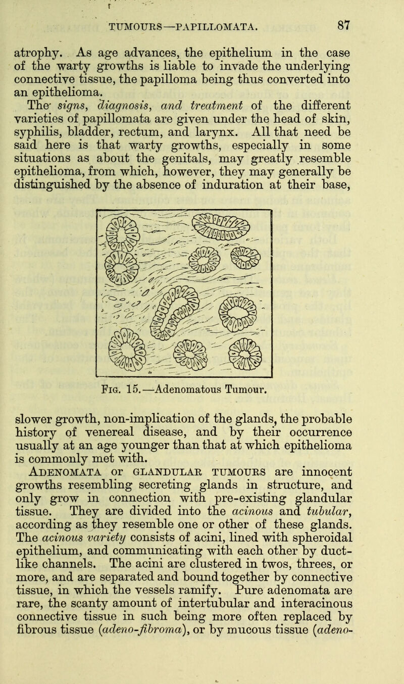 atrophy. As age advances, the epithelmm in the case of the warty growths is liable to invade the underlying connective tissue, the papilloma being thus converted into an epithelioma. The' signs^ diagnosis, and treatment of the different varieties of papillomata are given under the head of skin, syphilis, bladder, rectum, and larynx. All that need be said here is that warty growths, especially in some situations as about the genitals, may greatly resemble epithelioma, from which, however, they may generally be distinguished by the absence of induration at their base, Fig. 15.—Adenomatous Tumour. slower growth, non-implication of the glands, the probable history of venereal disease, and by their occurrence usually at an age younger than that at which epithelioma is commonly met with. Adenomata or glandular tumours are innocent growths resembling secreting glands in structure, and only grow in connection with pre-existing glandular tissue. They are divided into the acinous and tubular, according as they resemble one or other of these glands. The acinous variety consists of acini, lined with spheroidal epithelium, and communicating with each other by duct- like channels. The acini are clustered in twos, threes, or more, and are separated and bound together by connective tissue, in which the vessels ramify. Pure adenomata are rare, the scanty amount of intertubular and interacinous connective tissue in such being more often replaced by fibrous tissue (adeno-fihroma), or by mucous tissue {adeno-