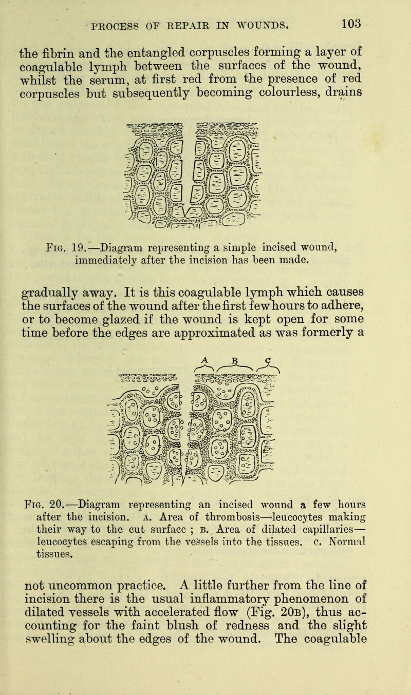 tlie fibrin and the entangled corpuscles forming a layer of coagulable lymph, between the surfaces of the wound, whilst the serum, at first red from the presence of red corpuscles but subsequently becoming colourless, drains Fia. 19.—Diagram representing a simple incised wound, immediately after the incision has been made. gradually away. It is this coagulable lymph which causes the surfaces of the wound after the first few hours to adhere, or to become glazed if the wound is kept open for some time before the edges are approximated as was formerly a Fig. 20.—Diagram representing an incised wound a few hours after the incision. A. Area of thrombosis—^leucocytes making their way to the cut surface ; b. Area of dilated capillaries— leucocytes escaping from the vessels into the tissues, c. Normal tissues. not uncommon practice. A little further from the line of incision there is the usual inflammatory phenomenon of dilated vessels with accelerated flow (Fig. 20b), thus ac- counting for the faint blush of redness and the slight swelling a>bout the edges of the wound. The coagulable