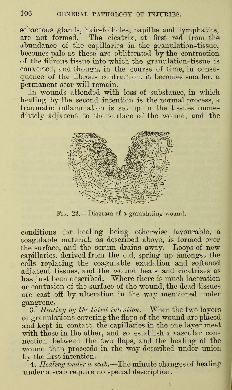 sebaceous glands, hair-follicles, papillae and lymphatics, are not formed. The cicatrix, at first red from the abundance of the capillaries in the granulation-tissue, becomes pale as these are obliterated by the contraction of the fibrous tissue into which the granulation-tissue is converted, and though, in the course of time, in conse- quence of the fibrous contraction, it becomes smaller, a permanent scar will remain. In wounds attended with loss of substance, in which healing by the second intention is the normal process, a traumatic inflammation is set up in the tissues imme- diately adj acent to the surface of the wound, and the Fig. 23.—Diagram of a granulating wound, conditions for healing being otherwise favourable, a coagulable material, as described above, is formed over the surface, and the serum drains away. Loops of new capillaries, derived from the old, spring up amongst the cells replacing the coagulable exudation and softened adjacent tissues, and the wound heals and cicatrizes as has just been described. Where there is much laceration or contusion of the surface of the wound, the dead tissues are cast o:ff by ulceration in the way mentioned under gangrene. 3. Healing hy the third intention,—When the two layers of granulations covering the flaps of the wound are placed and kept in contact, the capillaries in the one layer meet with those in the other, and so establish a vascular con- nection between the two flaps, and the healing of the wound then proceeds in the way described under union by the first intention. 4. Healing under a scah.—The minute changes of healing under a scab require no special description.