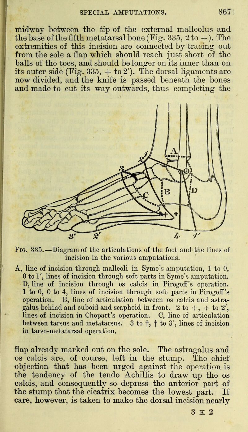 SPECIAL AMPUTATIONS. 867 i ^ . inidway between the tip of the external malleolus and tlie base of the fifth metatarsal bone (Fig. 335, 2 to +). The extremities of this incision are connected by tracing out j from the sole a flap which should reach just short of the j balls of the toes, and should be longer on its inner than on I its outer side (Fig. 335, + to 2'). The dorsal ligaments are ! now divided, and the knife is passed beneath the bones and made to cut its way outwards, thus completing the Fig. 335.—Diagram of tlie articulations of the foot and the lines of incision in the various amputations. A, line of incision through malleoli in Syme's amputation, 1 to 0, 0 to 1', lines of incision through soft parts in Syme's amputation. D, line of incision through os calcis in PirogofF's operation. 1 to 0, 0 to 4, lines of incision through soft parts in Pirogoff's operation. B, line of articulation between os calcis and astra- galus behind and cuboid and scaphoid in front. 2 to +, + to 2', lines of incision in Chopart's operation. C, line of articulation between tarsus and metatarsus. 3 to f, f to 3', lines of incision in tarso-metatarsal operation. flap already marked out on the sole. The astragalus and OS calcis are, of course, left in the stump. The chief objection that has been urged against the operation is the tendency of the tendo Achillis to draw up the os calcis, and consequently so depress the anterior part of the stump that the cicatrix becomes the lowest part. If care, however, is taken to make the dorsal incision nearly 3 K 2