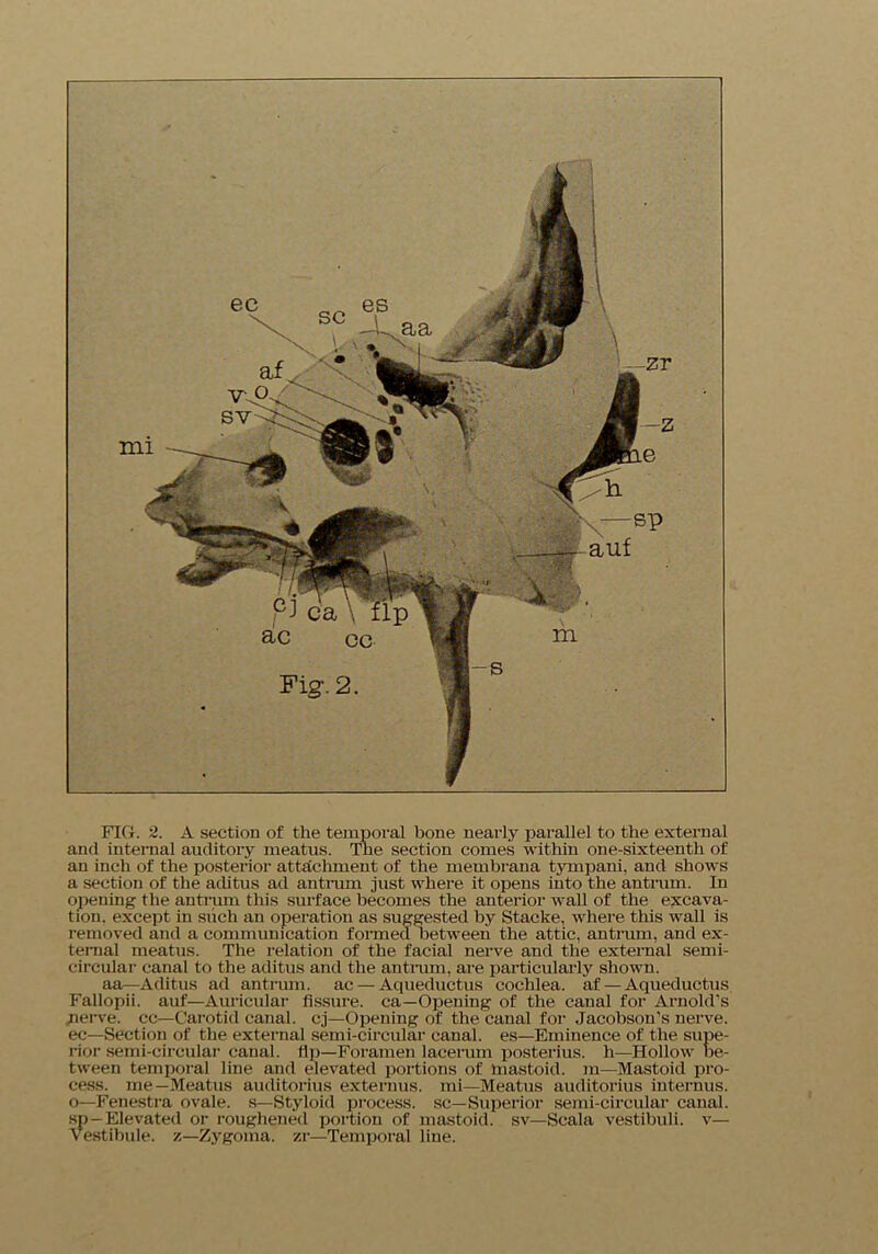 FIG. 2. A section of the temporal bone nearly parallel to the external and internal auditory meatus. Toe section comes within one-sixteenth of an inch of the posterior attachment of the membraua tympani. and shows a section of the aditus ad antrum just where it opens into the antrum. In opening the antrum this surface becomes the anterior wall of the excava- tion. except in such an operation as suggested by Stacke, where this wall is removed and a communication formed between the attic, antrum, and ex- ternal meatus. The relation of the facial nerve and the external semi- circular canal to the aditus and the antrum, are particularly shown. aa—Aditus ad antrum, ac — Aqueductus cochlea, af — Aqueductus Fallopii. auf—Auricular fissure, ca—Opening of the canal for Arnold's nerve, cc—Carotid canal, cj—Opening of the canal for Jacobson’s nerve, ec—Section of the external semi-circular canal, es—Eminence of the supe- rior semi-circular canal. Up—Foramen lacerum posterius. li—Hollow be- tween temporal line and elevated portions of mastoid, m—Mastoid pro- cess. me—Meatus auditorius externus. mi—Meatus auditorius iuternus. o—Fenestra ovale, s—Styloid process, sc—Superior semi-circular canal, sp-Elevated or roughened portion of mastoid, sv—Scala vestibuli. v— Vestibule, z—Zygoma. zr—Temporal line.