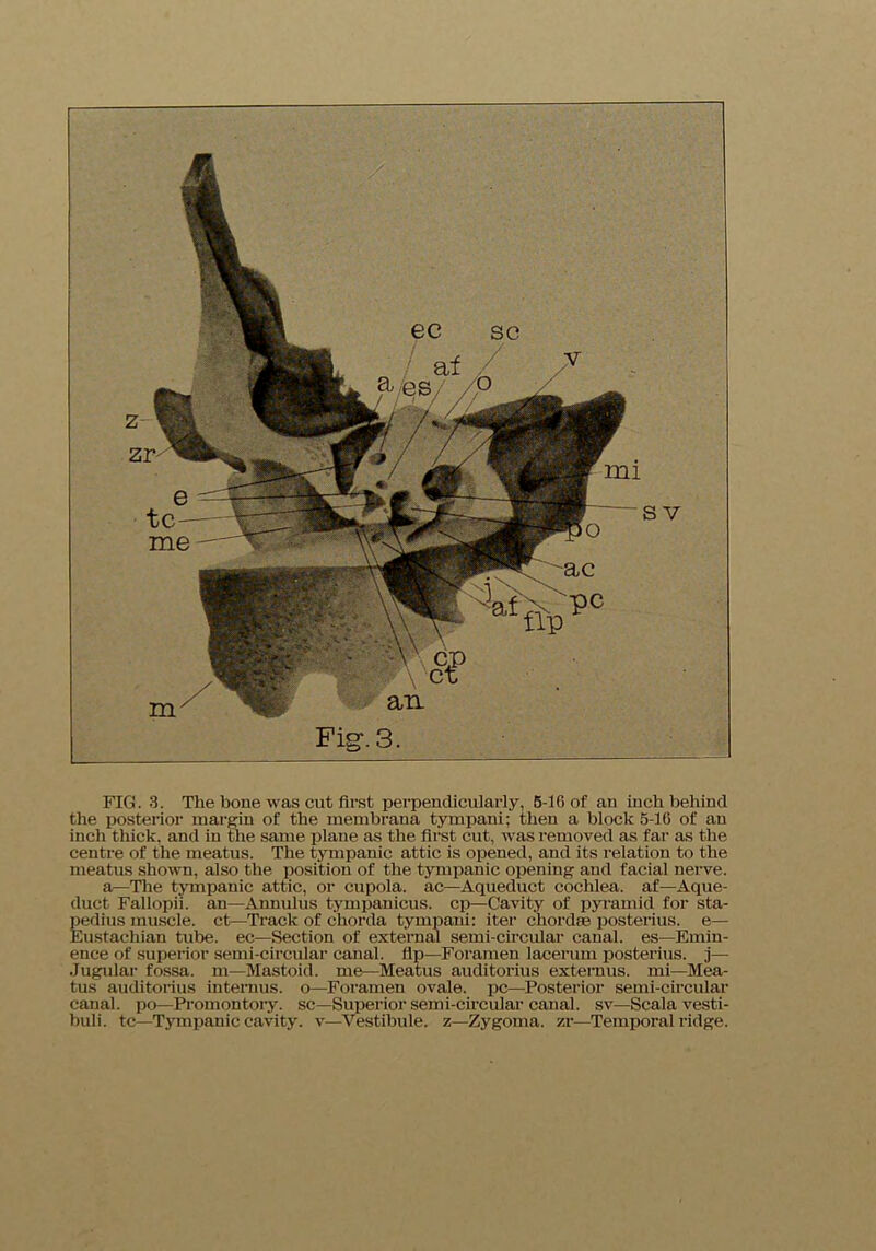 FIG. 3. The bone was cut first perpendicularly, 5-16 of an inch behind the posterior margin of the membrana tympani; then a block 5-16 of an inch thick, and in the same plane as the first cut, was removed as far as the centre of the meatus. The tympanic attic is opened, and its relation to the meatus shown, also the position of the tympanic opening and facial nerve. a—The tympanic attic, or cupola, ac—Aqueduct cochlea, af—Aque- duct Fallopii. an—Annulus tympanicus. cp—Cavity of pyramid for sta- pedius muscle, ct—Track of chorda tympani: iter chordae posterius. e— Eustachian tube, ec—Section of external semi-circular canal, es—Emin- ence of superior semi-circular canal, dp—Foramen lacerum posterius. j— Jugular fossa, m—Mastoid, me—Meatus auditorius externus. mi—Mea- tus* auditorius intemus. o—Foramen ovale, pc—Posterior semi-circular canal, po—Promontory, sc—Superior semi-circular canal, sv—Scala vesti- buli. tc—Tympanic cavity, v—Vestibule, z—Zygoma, zr—Temporal ridge.