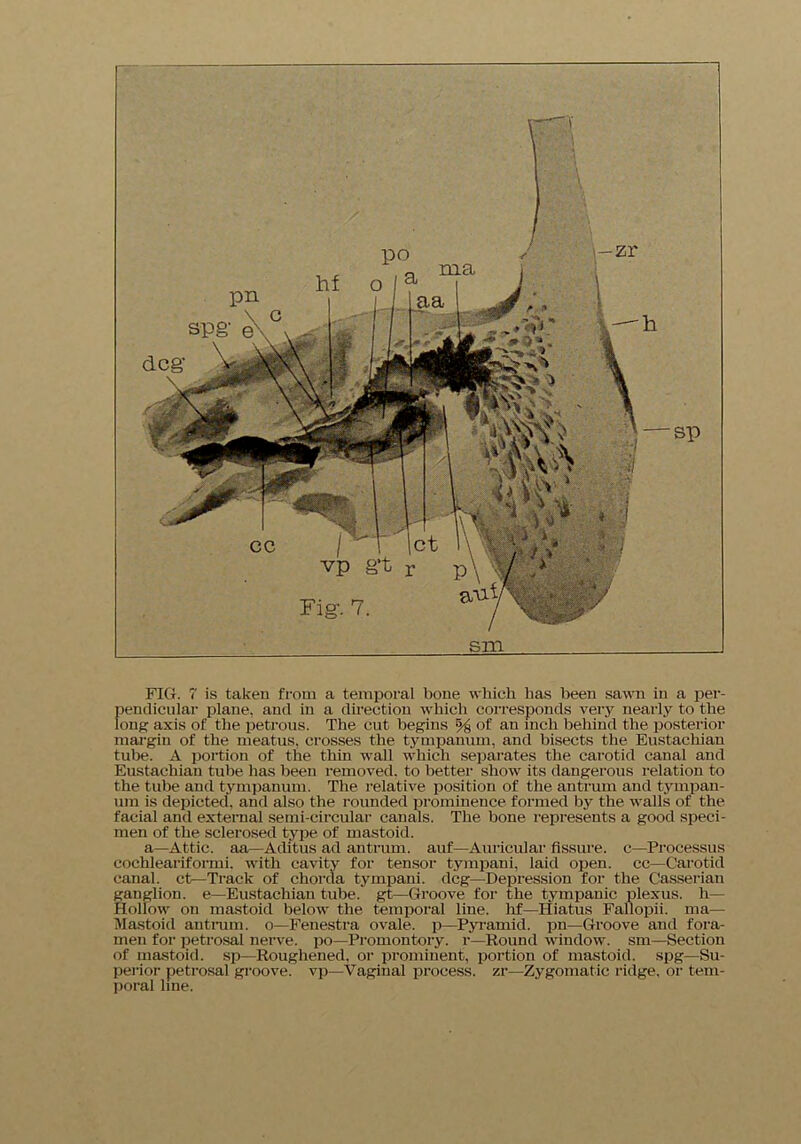 sm FIG. 7 is taken from a temporal bone which has been sawn in a per- pendicular plane, and in a direction which corresponds very nearly to the long axis of the petrous. The cut begins % of an inch behind the posterior margin of the meatus, crosses the tympanum, and bisects the Eustachian tube. A portion of the thin wall which separates the carotid canal and Eustachian tube has been removed, to better show its dangerous relation to the tube and tympanum. The relative position of the antrum and tympan- um is depicted, and also the rounded prominence formed by the walls of the facial and external semi-circular canals. The bone represents a good speci- men of the sclerosed type of mastoid. a—Attic, aa—Aditus ad antrum, auf—Auricular fissure, c—Processus cochleariformi. with cavity for tensor tympani, laid open, cc—Carotid canal, ct—Track of chorda tympani. deg—Depression for the Gasserian ganglion, e—Eustachian tube, gt—Groove for the tympanic plexus, h— Hollow on mastoid below the temporal line, lif—Hiatus Fallopii. ma— Mastoid antrum, o—Fenestra ovale, p—Pyramid, pn—Groove and fora- men for petrosal nerve, po—Promontory, r—Round window, sm—Section of mastoid, sp—Roughened, or prominent, portion of mastoid, spg—Su- perior petrosal groove, vp—Vaginal process, zr—Zygomatic ridge, or tem- poral line.