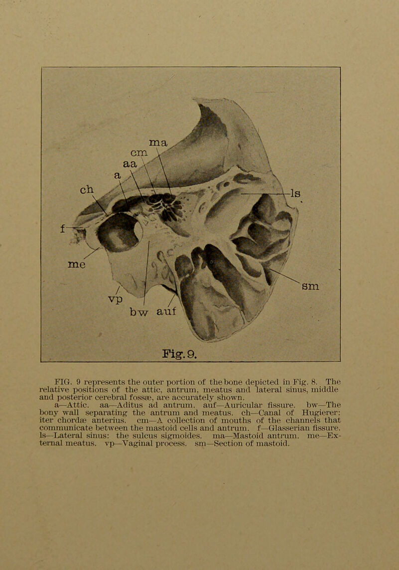 relative positions of the attic, antrum, meatus and lateral sinus, middle and posterior cerebral fossae, are accurately shown. a—Attic, aa—Aditus ad antrum, auf—Auricular fissure, bw—The bony wall separating the antrum and meatus, ch—Canal of Hugierer: iter chordae anterius. cm—A collection of mouths of the channels that communicate between the mastoid cells and antrum, f—Glassei’iau fissure. Is—Lateral sinus: the sulcus sigmoides. ma—Mastoid antrum, me—Ex- ternal meatus, vp—Vaginal process, sm—Section of mastoid.