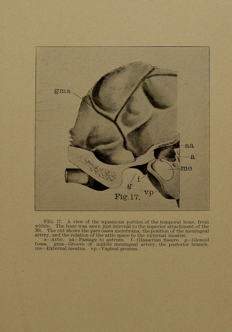 FIG. 17. A view of the squamous portion of the temporal hone, from within. The hone was sawn just internal to the superior attachment of the Mt. The cut shows the pars ossea membrana, the position of the meniugeal artery, and the relation of the attic space to the external meatus. a—Attic, aa—Passage to antrum, f—Glasserian fissure, g—Glenoid fossa, gma—Groove of middle meningeal artery, the posterior branch, me—External meatus, vp—Vaginal process.