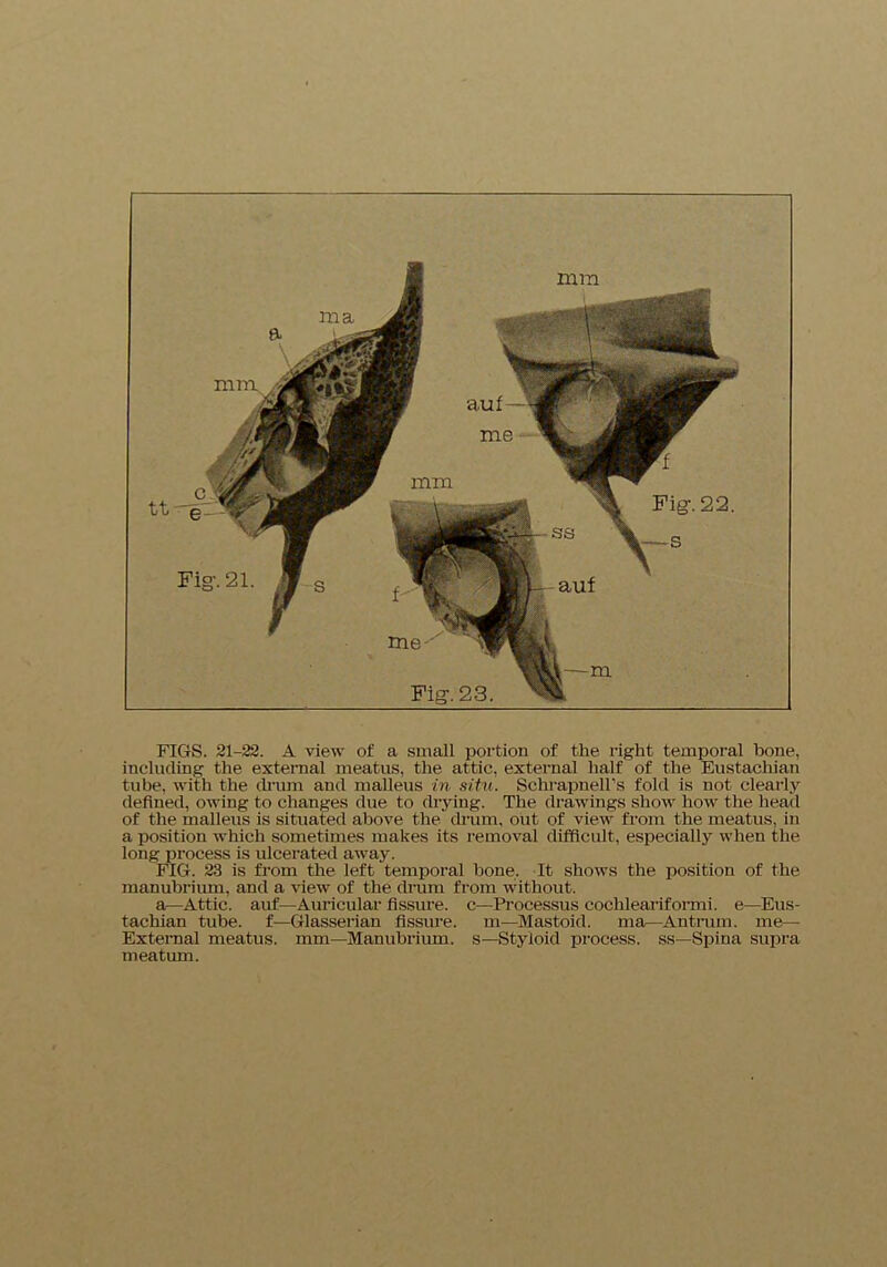 mm Fig-. 22. auf m ma auf me mm Fig-. 23. FIGS. 21-22. A view of a small portion of the right temporal bone, including the external meatus, the attic, external half of the Eustachian tube, with the drum and malleus in situ. Schrapnell's fold is not clearly defined, owing to changes due to drying. The drawings show how the head of the malleus is situated above the drum, out of view from the meatus, in a position which sometimes makes its removal difficult, especially when the long process is ulcerated away. FIG. 23 is from the left temporal hone. It shows the position of the manubrium, and a view of the drum from without. a—Attic, auf—Auricular fissure, c—Processus cochleariformi. e—Eus- tachian tube, f—Glasserian fissure, m—Mastoid, ma—Antrum, me— External meatus, mm—Manubrium, s—Styloid process, ss—Spina supra meatum.