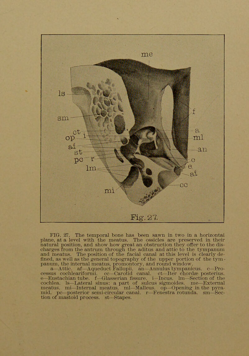 FIG. 27. The temporal hone has been sawn in two in a horizontal plane, at a level with the meatus. The ossicles are preserved in their natural position, and show how great an obstruction they offer to the dis- charges from the antrum through the aditus and attic to the tympanum and meatus. The position of the facial canal at this level is clearly de- fined, as well as the general topography of the upper portion of the tym - panum, the internal meatus, promontory, and round window. a—Attic, af—Aqueduct Fallopii. an—Annulus tympanicus. c—Pro- cessus cochleariformi. cc—Carotid canal, ct—Iter chordae posterius. e—Eustachian tube, f—Glasserian fissure, i—Incus, lm—Section of the cochlea. Is—Lateral sinus: a part of sulcus sigmoides. me—External meatus, mi—Internal meatus, ml—Malleus, op—Opening in the pyra- mid. pc—posterior semi-circular canal, r—Fenestra rotunda, sm—Sec- tion of mastoid process, st—Stapes.