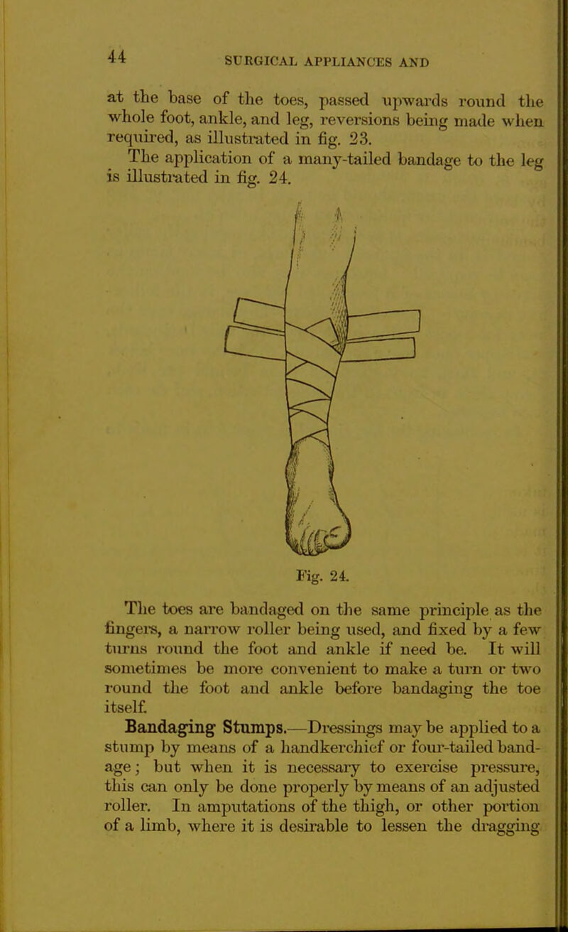 at the base of the toes, passed upwards round the whole foot, ankle, and leg, reversions being made when required, as illustrated in fig. 23. The application of a many-tailed bandage to the leg is illustrated in fig. 24. Fig. 24. The toes are bandaged on the same principle as the fingers, a narrow roller being used, and fixed by a few turns round the foot and ankle if need be. It will sometimes be more convenient to make a turn or two round the foot and ankle before bandaging the toe itself Bandaging Stumps.—Dressings may be applied to a stump by means of a handkerchief or four-tailed band- age ; but when it is necessary to exercise pressure, this can only be done properly by means of an adjusted roller. In amputations of the thigh, or other portion of a limb, where it is desirable to lessen the dragging