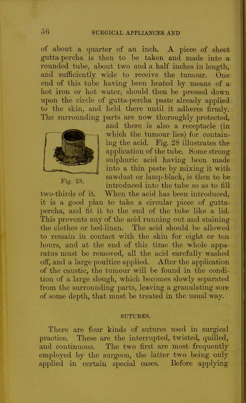 of about a quarter of an inch. A piece of sheet gutta-percha is then to be taken and made into a rounded tube, about two and a half inches in length, and sufficiently wide to receive the tumour. One end of this tube having been heated by means of a hot iron or hot water, should then be pressed down upon the circle of gutta-percha paste already applied to the skin, and held there until it adheres firmly. The surrounding parts are now thoroughly protected, and there is also a receptacle (in which the tumour lies) for contain- ing the acid. Fig. 28 illustrates the application of the tube. Some strong sulphuric acid having been made into a thin paste by mixing it with Fif 28 sawdust or lamp-black, is then to be introduced into the tube so as to fill two-thirds of it. When the acid has been introduced, it is a good plan to take a circular piece of gutta- percha., and fit it to the end of the tube like a Lid. This prevents any of the acid running out and staining the clothes or bed-linen. The acid should be allowed to remain in contact with the skin for eight or ten horn's, and at the end of this time the whole appa- ratus must be removed, all the acid carefully washed off, and a large poultice applied. After the application of the caustic, the tumour will be found in the condi- tion of a large slough, which becomes slowly separated from the surrounding parts, leaving a granulating sore of some depth, that must be treated in the usual way. SUTURES. There are four kinds of sutures used in surgical practice. These are the interrupted, twisted, quilled, and continuoiis. The two first are most frequently employed by the surgeon, the latter two being only applied in certain special cases. Before applying