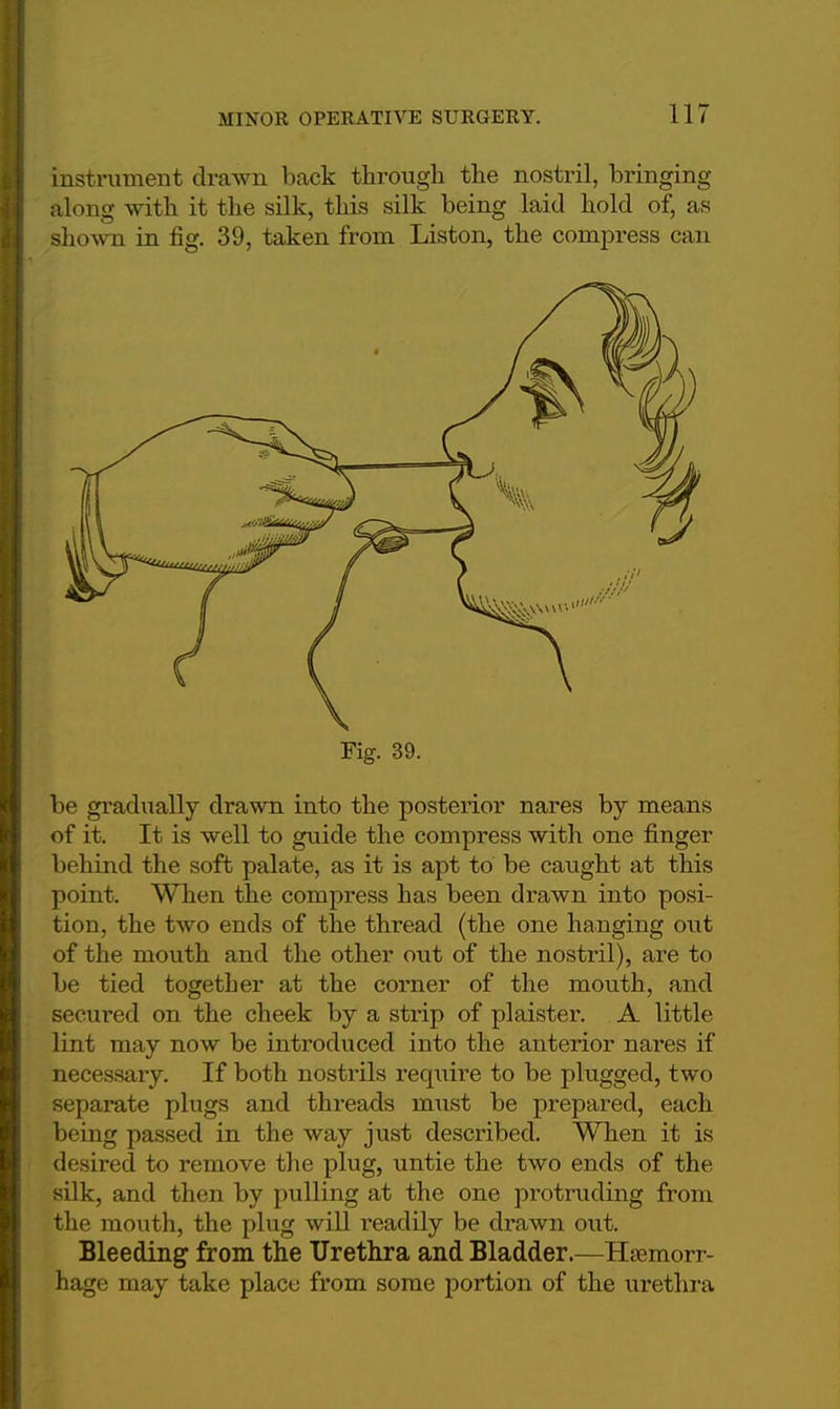 instrument draAvn back through the nostril, bringing along with it the silk, this silk being laid hold of, as shown in fig. 39, taken from Liston, the compress can Fig. 39. be gradually drawn into the posterior nares by means of it. It is well to guide the compress with one finger behind the soft palate, as it is apt to be caught at this point. When the compress has been drawn into posi- tion, the two ends of the thread (the one hanging out of the mouth and the other out of the nostril), are to be tied together at the corner of the mouth, and secured on the cheek by a strip of plaister. A little lint may now be introduced into the anterior nares if necessary. If both nostrils require to be plugged, two separate plugs and threads must be prepared, each being passed in the way just described. When it is desired to remove the plug, untie the two ends of the silk, and then by pulling at the one protruding from the mouth, the plug will readily be drawn out. Bleeding from the Urethra and Bladder.—Hemorr- hage may take place from some portion of the urethra
