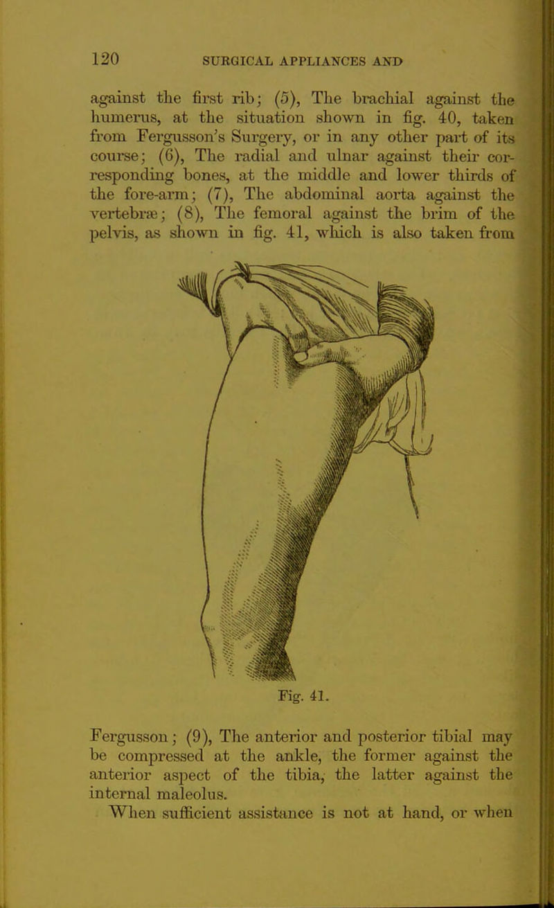 against the first rib; (5), The brachial against the humerus, at the situation shown in fig. 40, taken from Fergusson's Surgery, or in any other part of its course; (6), The radial and ulnar against their cor- responding bones, at the middle and lower thirds of the fore-aron; (7), The abdominal aorta against the vertebrae; (8), The femoral against the brim of the pelvis, as shown in fig. 41, which is also taken from Fig. 41. Fergusson; (9), The anterior and posterior tibial may be compressed at the ankle, the former against the anterior aspect of the tibia, the latter against the internal maleolus. When sufficient assistance is not at hand, or when