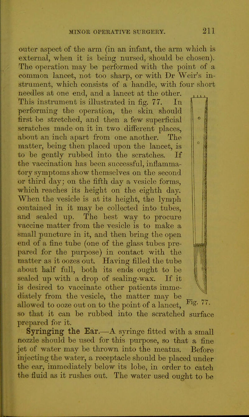 outer aspect of the arm (in an infant, the arm which is external, when it is being nursed, should be chosen). The operation may be performed with the point of a common lancet, not too sharp, or with Dr Weir's in- strument, which consists of a handle, with four short needles at one end, and a lancet at the other. This instrument is illustrated in fig. 77. In performing the operation, the skin should first be stretched, and then a few superficial scratches made on it in two different places, about an inch apart from one another. The matter, being then placed upon the lancet, is to be gently rubbed into the scratches. If the vaccination has been successful, inflamma- tory symptoms show themselves on the second or third day; on the fifth day a vesicle forms, which reaches its height on the eighth day. When the vesicle is at its height, the lymph contained in it may be collected into tubes, and sealed up. The best way to procure vaccine matter from the vesicle is to make a small puncture in it, and then bring the open end of a fine tube (one of the glass tubes pre- pared for the purpose) in contact with the matter as it oozes out. Having filled the tube about half full, both its ends ought to be sealed up with a drop of sealing-wax. If it is desired to vaccinate other patients imme- diately from the vesicle, the matter may be allowed to ooze out on to the point of a lancet, '1' so that it can be rubbed into the scratched surface prepared for it. Syringing the Ear.—A syringe fitted with a small nozzle should be used for this purpose, so that a fine jet of water may be thrown into the meatus. Before injecting the water, a receptacle should be placed under the ear, immediately below its lobe, in order to catch the fluid as it rushes out. The water used ought to be