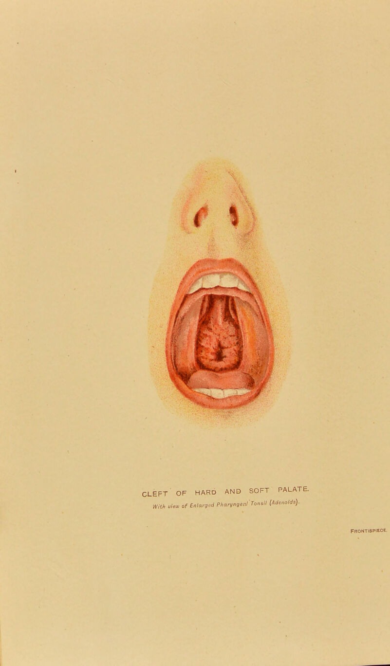 CLEFT OF HARD AND SOFT PALATE. With view of Enlarged Pharyngeal Tonsil (Adenoids). FRONTISPIECE