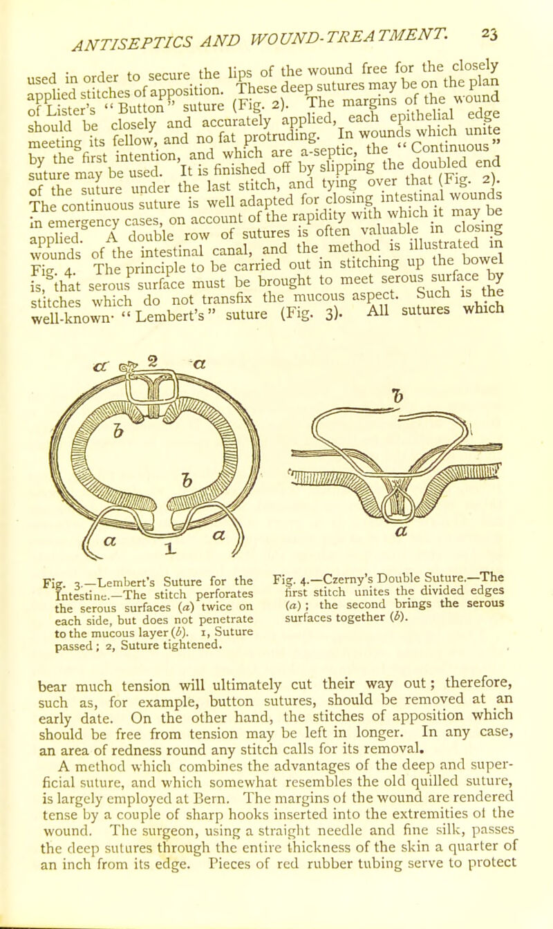 bv tKrst intent on, and which are a-septic, *e  Contmuous Sture may be used. It is finished off by slipping the doubled end of the^ulure under the last stitch, and tying over that Fig. 2). Thrcont nrus su^^^^^ is well adapted for closing mtestma wounds J^^emerg ncy cases, on account of the rapidity with which it may be applTedr A double row of sutures is often valuable in closing Znds of the intestinal canal, and the. method is ^ ^^r^ted in Fie- d The principle to be carried out in stitching up the bowel J Vat ser'is^urfa'ce must be brought to meet -rous surface by St tches which do not transfix the mucous aspect. Such is the well kLwn ''Lembert's suture (Fig. 3)- All sutures which Fig. 3.—Lembert's Suture for the Intestine.—The stitch perforates the serous surfaces (rt) twice on each side, but does not penetrate to the mucous layer (A), i, Suture passed; 2, Suture tightened. Fig. 4.—Czemy's Double Suture.—The first stitch unites the divided edges (a); the second brings the serous surfaces together {6). bear much tension will ultimately cut their way out; therefore, such as, for example, button sutures, should be removed at an early date. On the other hand, the stitches of apposition which should be free from tension may be left in longer. In any case, an area of redness round any stitch calls for its removal. A method which combines the advantages of the deep and super- ficial suture, and which somewhat resembles the old quilled suture, is largely employed at Bern. The margins of the wound are rendered tense by a couple of sharp hooks inserted into the extremities ol the wound. The surgeon, using a straight needle and fine silk, passes the deep sutures through the entire thickness of the skin a quarter of an inch from its edge. Pieces of red rubber tubing serve to protect