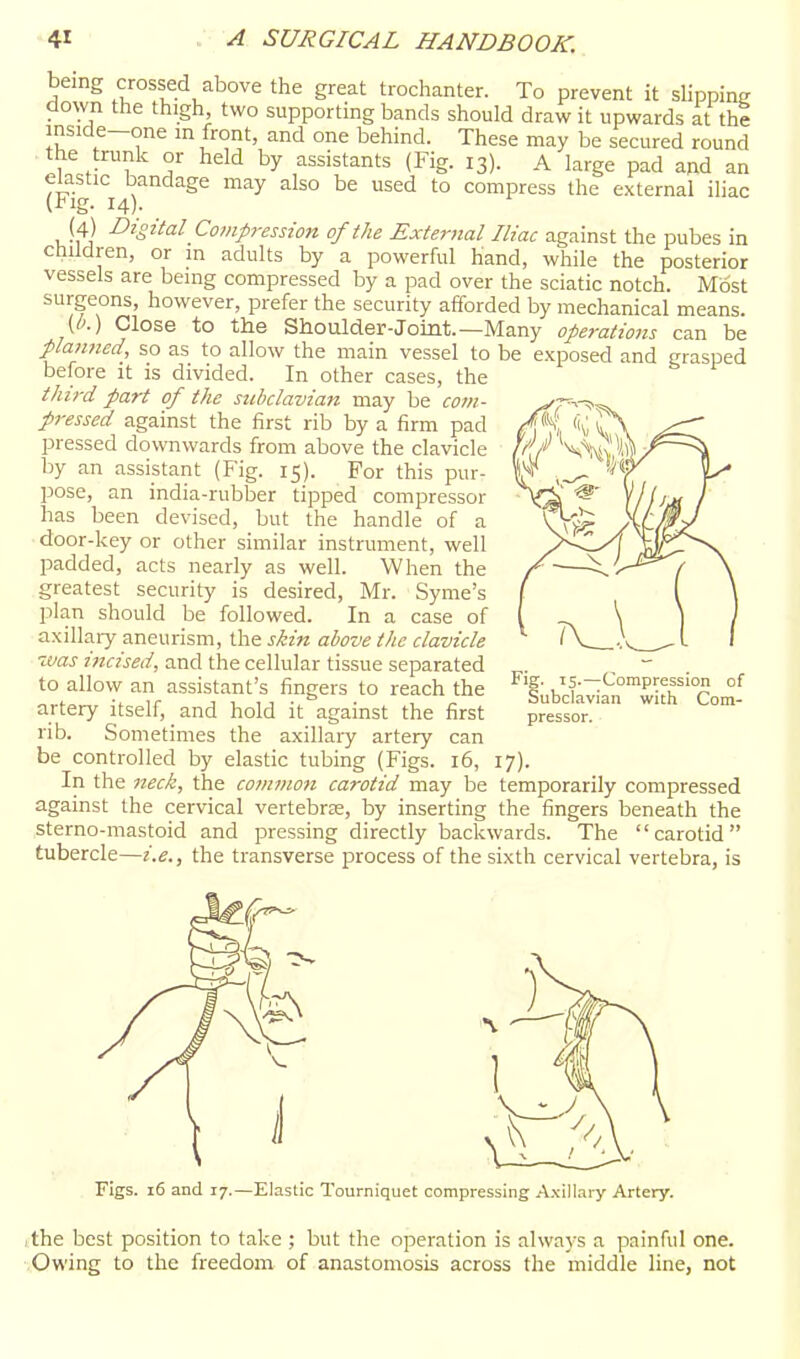 being crossed above the great trochanter. To prevent it slipping down the thigh, two supporting bands should draw it upwards at the inside-one in front, and one behind. These may be secured round the trunk or held by assistants (Fig. 13). A large pad and an elastic bandage may also be used to compress the external iliac trig. 14). (4) Digital Compression of the External Iliac against the pubes in children, or m adults by a powerful hand, while the posterior vessels are being compressed by a pad over the sciatic notch. Most surgeons, however, prefer the security afforded by mechanical means. (/'.) Close to the Shoulder-Joint.—Many operations can be planned, so as to allow the main vessel to be exposed and grasped before it is divided. In other cases, the third part of the subclavian may be com- pressed against the first rib by a firm pad pressed downwards from above the clavicle by an assistant (Fig. 15). For this pur- pose, an india-rubber tipped compressor has been devised, but the handle of a door-key or other similar instrument, well padded, acts nearly as well. When the greatest security is desired, Mr. Syme's plan should be followed. In a case of axillai7 aneurism, the skin above the clavicle ivas incised, and the cellular tissue separated to allow an assistant's fingers to reach the artery itself, and hold it against the first rib. Sometimes the axillary artery can be controlled by elastic tubing (Figs. 16, 17). In the neck, the cominon carotid may be temporarily compressed against the cervical vertebras, by inserting the fingers beneath the sterno-mastoid and pressing directly backwards. The carotid tubercle—i.e., the transverse process of the sixth cervical vertebra, is Fig. TS.—Compression of Subclavian with Com- pressor. Figs. 16 and 17.—Elastic Tourniquet compressing Axillary Artery. the best position to take ; but the operation is always a painful one. Owing to the freedom of anastomosis across the middle line, not