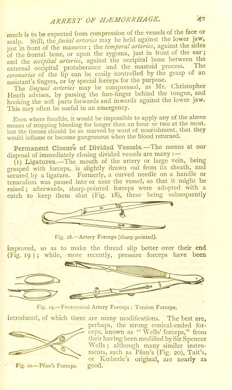 much is to be expected from compression of the vessels of the face or scalp. Still, th^ facial arieries may be held against the lower jaw, just in front of the masseter ; the temporal arteries, against the sides of the frontal bone, or upon the zygoma, just in front of the ear ; and the occipital arteries, against the occipital bone between the external occipital protuberance and the mastoid process. The corollaries of the lip can be easily controlled by the grasp of an assistant's fingers, or by special forceps for the purpose. The lingual arteries may be compressed, as Mr. Christopher Heath advises, by passing the fore-finger behind the tongue, and hooking the soft parts forwards and inwards against the lower jaw. This may often be useful in an emergency. Even where feasible, it would be impossible to apply any of the above means of stopping bleeding for longer than an hour or two at the most, lest the tissues should be so starved by want of nourishment, that they would inflame or become gangrenous when the blood returned. Permanent Closure of Divided Vessels.—The means at our disposal of immediately closing divided vessels are many :— (i) Ligatiires.—The mouth of the artery or large vein, being grasped with forceps, is slightly drawn out from its sheath, and secured by a ligature. Formerly, a curved needle on a handle or tenaculum was passed into or near the vessel, so that it might be raised; afterwards, sharp-pointed forceps were adopted with a catch to keep them shut (Fig. 18), these being subsequently Fig. 18.—Artery Forceps (sharp pointed). improved, so as to make the thread sUp better over their end (Fig. 19 ) ; while, more recently, pressure forceps have been Fig. ig.—Fcr.eatraled Arter>' Forceps ; Torsion Forceps. introduced, of which there are many modifications. The best are, perhaps, the strong conical-ended for- ceps, known as  Wells' forceps, from their having been modified by Sir Spencer Wells; although many similar instru- ments, such as P@an's (Fig. 20), Tail's, or Kccberle's original, are nearly as Fig. 20.—Plan's Forceps. good.