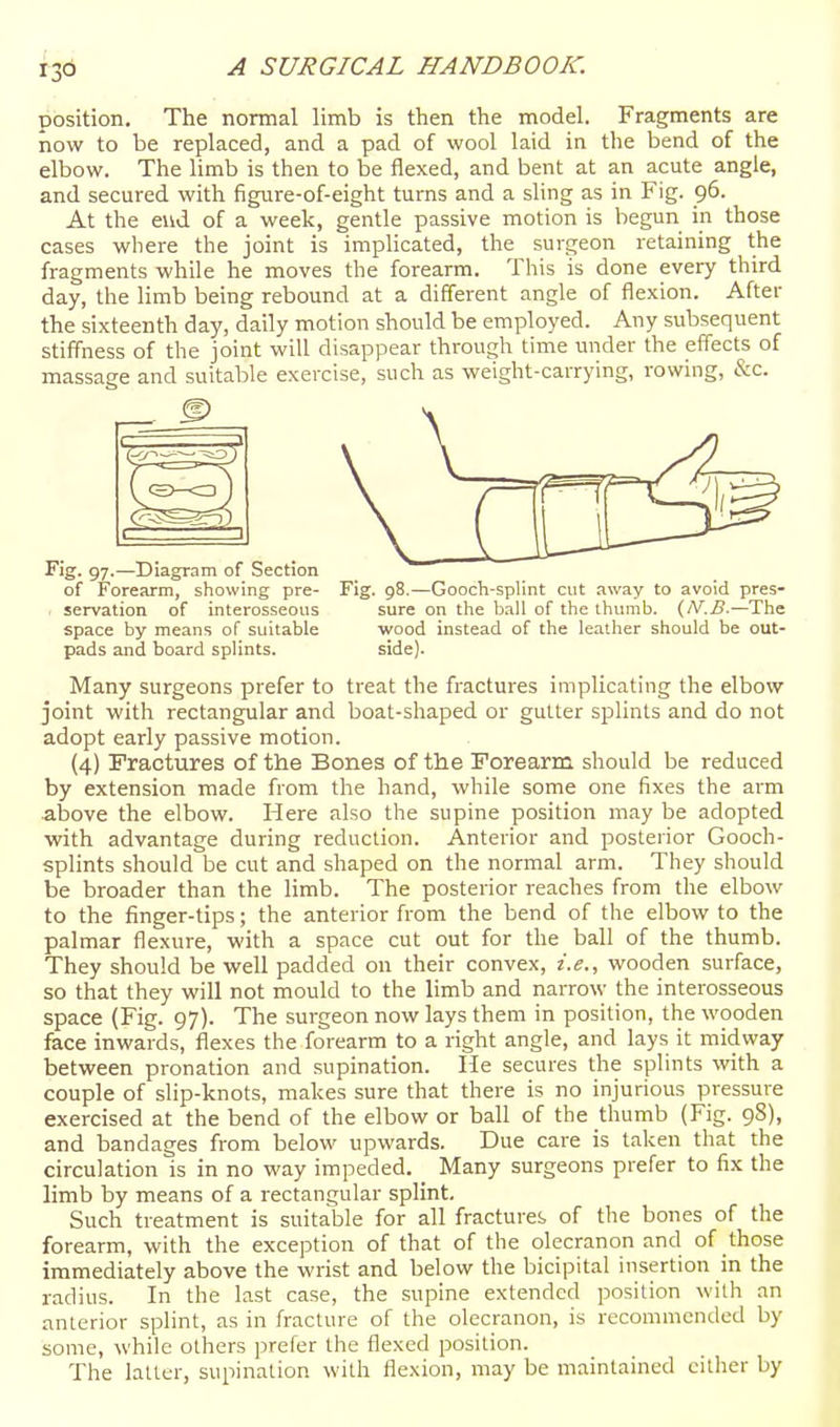 position. The normal limb is then the model. Fragments are now to be replaced, and a pad of wool laid in the bend of the elbow. The limb is then to be flexed, and bent at an acute angle, and secured with figure-of-eight turns and a sling as in Fig. 96. At the eud of a week, gentle passive motion is begun in those cases where the joint is implicated, the surgeon retaining the fragments while he moves the forearm. This is done every third day, the limb being rebound at a different angle of flexion. After the sixteenth day, daily motion should be employed. Any subsequent stiffness of the joint will disappear through time under the effects of massage and suitable exercise, such as weight-carrying, rowing, &c. Fig. 97.—Diagram of Section of Forearm, showing pre- , servation of interosseous space by means of suitable pads and board splints. Fig. 98.—Gooch-splint cut away to avoid pres- sure on the ball of the thumb. (/V./?.—The wood instead of the leather should be out- side). Many surgeons prefer to treat the fractures implicating the elbow joint with rectangular and boat-shaped or gutter splints and do not adopt early passive motion. (4) Fractures of the Bones of the Forearm should be reduced by extension made from the hand, while some one fixes the arm above the elbow. Here also the supine position may be adopted with advantage during reduction. Anterior and posterior Gooch- splints should be cut and shaped on the normal arm. They should be broader than the limb. The posterior reaches from the elbow to the finger-tips; the anterior from the bend of the elbow to the palmar flexure, with a space cut out for the ball of the thumb. They should be well padded on their convex, i.e., wooden surface, so that they will not mould to the limb and narrow the interosseous space (Fig. 97). The surgeon now lays them in position, the wooden face inwards, flexes the forearm to a right angle, and lays it midway between pronation and supination. He secures the splints with a couple of slip-knots, makes sure that there is no injurious pressure exercised at the bend of the elbow or ball of the thumb (Fig. 98), and bandages from below upwards. Due care is taken that the circulation is in no way impeded. Many surgeons prefer to fix the limb by means of a rectangular splint. Such treatment is suitable for all fractures of the bones of the forearm, with the exception of that of the olecranon and of those immediately above the wrist and below the bicipital insertion in the radius. In the last case, the supine extended position with an anterior splint, as in fracture of the olecranon, is recommended by some, while others prefer the flexed position. The latter, supination with flexion, may be maintained either by