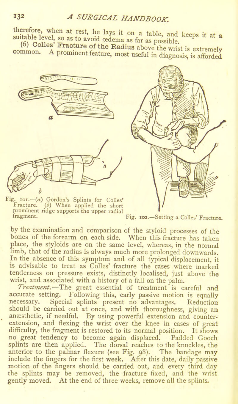 therefore, when at rest, he lays it on a table, and keeps it at a suitable level so as to avoid oedema as far as possible. ^ ^ (6) CoUes Fracture of the Radius above the wrist is extremelv common. A promment feature, most useful in diagnosi^ is affoS Fig. loi.—(rt) Gordon's Splints for Colles* Fracture, (b) When applied the short prominent ridge supports the upper radial fragment. Fig. I02.—Setting a Colles' Fracture by the examination and comparison of the styloid processes of the bones of the forearm on each side. When this fracture has taken place, the styloids are on the same level, whereas, in the normal limb, that of the radius is always much more prolonged downwards. In the absence of this symptom and of all typical displacement, it is advisable to treat as Colles' fracture the cases where marked tenderness on pressure exists, distinctly localised, just above the wrist, and associated with a history of a fall on the palm. Treatment.—The great essential of treatment is careful and accurate setting. Following this, early passive motion is equally necessary. Special splints present no advantages. Reduction should be carried out at once, and with thoroughness, giving an ansesthetic, if needful. By using powerful extension and counter- extension, and flexing the wrist over the knee in cases of great difficulty, the fragment is restored to its normal position. It shows no great tendency to become again displaced. Padded Gooch splints are then applied. The dorsal reaches to the knuckles, the anterior to the palmar flexure (see Fig. 98). The bandage may include the fingers for the first week. After this date, daily passive motion of the fingers should be carried out, and every third day the splints may be removed, the fracture fixed, and the wrist gently moved. At the end of three weeks, remove all the splints.