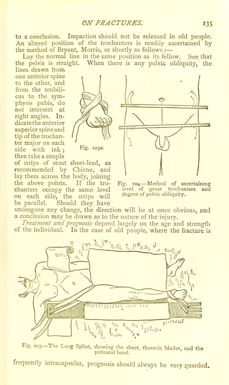 to a conclusion. Impaction should not be released in old people. An altered position of the trochanters is readily ascertained by the method of Bryant, Morris, or shortly as follows :— Lay the normal line in the same position as its fellow. See that the pelvis is straight. When there is any pelvic obliquity, the lines drawn from / one anterior spme to the other, and from the umbili- cus to the sym- physis pubis, do not intersect at right angles. In- dicate the anterior superior spine and tip of the trochan- ter major on each side with ink; then take a couple of strips of stout sheet-lead, as recommended by Chiene, and lay them across the body, joining the above points. If the tro- chanters occupy the same level on each side, the strips will be parallel. Should they have undergone any change, the direction will be at once obvious, and a conclusion may be drawn as to the nature of the injury. Treatment and prognosis depend largely on the age and strength of the individual. In the case of old people, where the fracture is Fig. 104.—Method of ascertaining level of great trochanters and degree of pelvic obliquity. Fig. los.-The Long Splint, showing the sheet, thoracic binder, and the perina:al band. frequently intracapsular, prognosis should always be veiy (yarded.