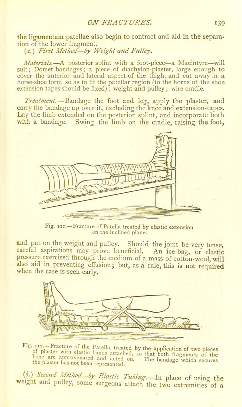 the ligamentum patellae also begin to contract and aid in the separa- tion of the lower fragment. {a.) First Method—by Weight and Pulley. Materials.—posterior splint with a foot-piece—a Macintyre—will suit; Domet bandages; a piece of diachylon-plaster, large enough to cover the anterior and lateral aspect of the thigh, and cut away in a horse-shoe form so as to fit the patellar region (to the horns of the shoe extension-tapes should be fixed); weight and pulley; wire cradle. Treatment.—Bandage the foot and leg, apply the plaster, and carry the bandage up over it, excluding the knee and extension-tapes. Lay the limb extended on the posterior splint, and incorporate both with a bandage. Swing the limb on the cradle, raising the foot. -Fracture of Patella treated by elastic extension on the inclined plane. and put on the weight and pulley. Should the joint be very tense, careful aspirations may prove beneficial. An ice-bag, or elastic pressure exercised through the medium of a mass of cotton-wool, will also aid in preventing effusion; but, as a rule, this is not required when the case is seen early. th™;,a^LrsTo;ren^;^;rlse^^1. ^'^^ -^-^^^^S se^u^ef wiiht'^Tr'^ ^ff'^~^y ^l^'iic Tubing.-l^-, place of using the weight and pulley, some surgeons attach the two extremities of a