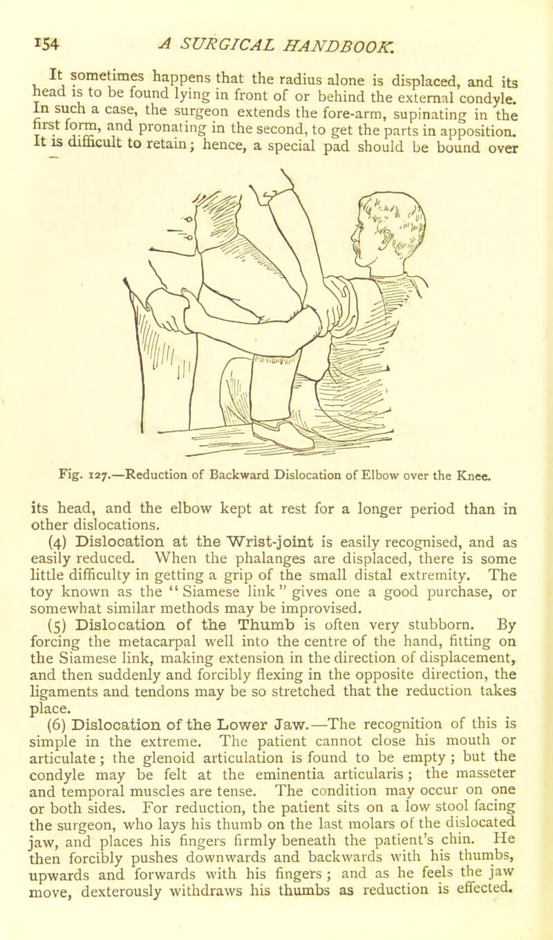 It sometimes happens that the radius alone is displaced, and its head IS to be found lying in front of or behind the external condyle. In such a case, the surgeon extends the fore-arm, supinating in the T -^ J.™' pronating in the second, to get the parts in apposition. It IS difficult to retain; hence, a special pad should be bound over Fig. 127.—Reduction of Backward Dislocation of Elbow over the Knee. its head, and the elbow kept at rest for a longer period than in other dislocations. (4) Dislocation at the Wrist-joint is easily recognised, and as easily reduced. When the phalanges are displaced, there is some little difficulty in getting a grip of the small distal extremity. The toy known as the Siamese link gives one a good purchase, or somewhat similar methods may be improvised. (5) Dislocation of the Thumb is often very stubborn. By forcing the metacai-pal well into the centre of the hand, fitting on the Siamese link, making extension in the direction of displacement, and then suddenly and forcibly flexing in the opposite direction, the ligaments and tendons may be so stretched that the reduction takes place. (6) Dislocation of the Lower Jaw.—The recognition of this is simple in the extreme. The patient cannot close his mouth or articulate ; the glenoid articulation is found to be empty ; but the condyle may be felt at the eminentia articularis; the masseter and temporal muscles are tense. The condition may occur on one or both sides. For reduction, the patient sits on a low stool facing the surgeon, who lays his thumb on the last molars of the dislocated jaw, and places his fingers firmly beneath the patient's chin. He then forcibly pushes downwards and backwards witii his tliunibs, upwards and forwards with his fingers ; and as he feels the jaw move, dexterously withdraws his thumbs as reduction is effected.