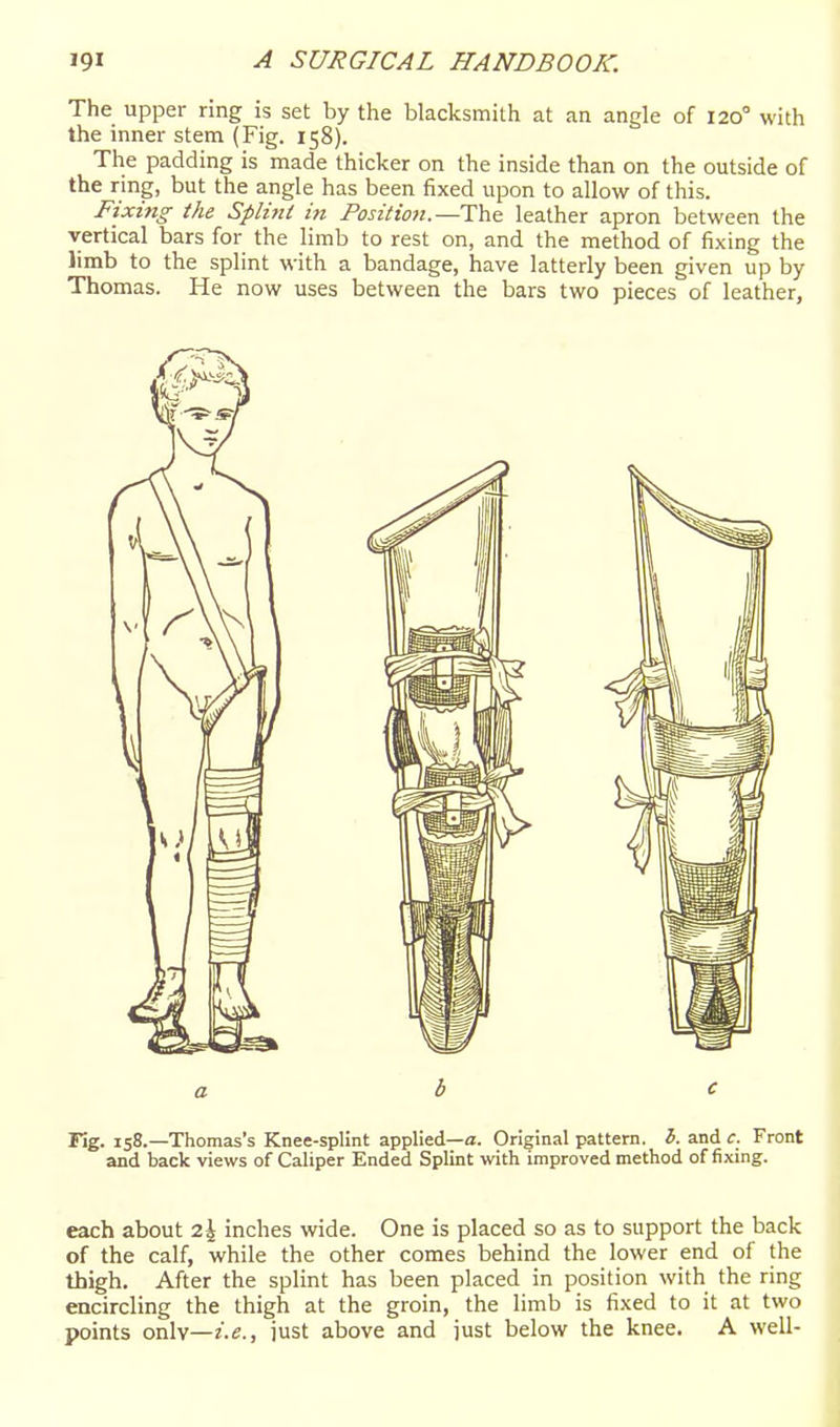 The upper ring is set by the blacksmith at an angle of 120° with the inner stem (Fig. 158). The padding is made thicker on the inside than on the outside of the ring, but the angle has been fixed upon to allow of this. Fixing the Splint in Position.—The leather apron between the vertical bars for the limb to rest on, and the method of fixing the limb to the splint with a bandage, have latterly been given up by Thomas. He now uses between the bars two pieces of leather, a b e rig. 158.—Thomas's Knee-splint applied—a. Original pattern, h. and c. Front and back views of Caliper Ended Splint with improved method of fixing. each about 2\ inches wide. One is placed so as to support the back of the calf, while the other comes behind the lower end of the thigh. After the splint has been placed in position with the ring encircling the thigh at the groin, the limb is fixed to it at two points only—just above and just below the knee. A well-