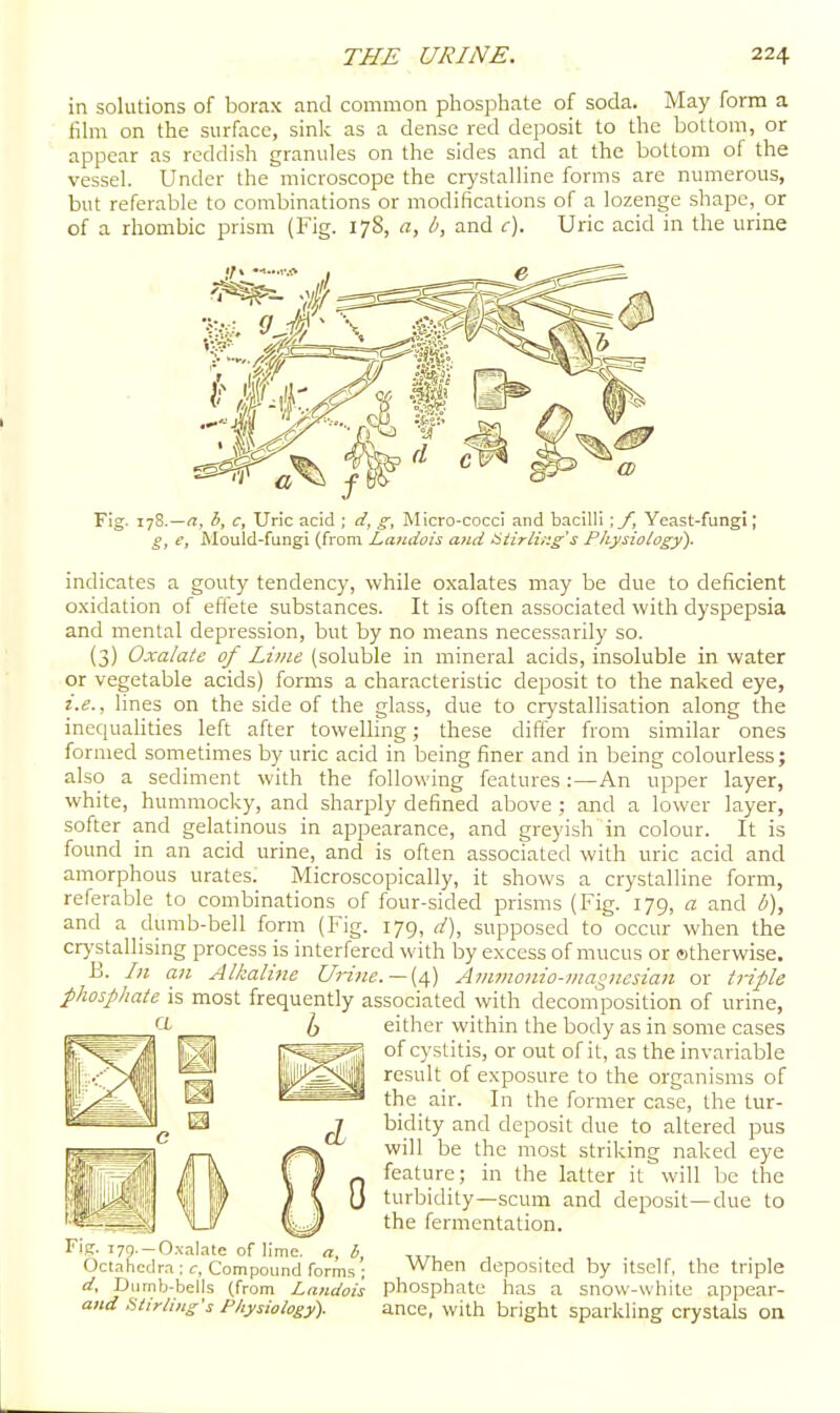 in solutions of borax and common phosphate of soda. May form a film on the surface, sink as a dense red deposit to the bottom, or appear as reddish granules on the sides and at the bottom of the vessel. Under the microscope the crystalline forms are numerous, but referable to combinations or modifications of a lozenge shape, or of a rhombic prism (Fig. 178, a, b, and c). Uric acid in the urine Tig- jyS.—n, b, c. Uric acid ; d, g, Micro-cocci and bacilli ;/, Yeast-fungi; e, iVlould-fungi (from Laiidois and ^tirlinss Physiology). indicates a gouty tendency, while oxalates may be due to deficient 0.xidation of eftete substances. It is often associated with dyspepsia and mental depression, but by no means necessarily so. (3) Oxalate of Lime (soluble in mineral acids, insoluble in water or vegetable acids) forms a characteristic deposit to the naked eye, 1. e., lines on the side of the glass, due to crystallisation along the inequahties left after towelling; these differ from similar ones formed sometimes by uric acid in being finer and in being colourless; also a sediment with the following features:—An upper layer, white, humniocky, and sharply defined above ; and a lower layer, softer and gelatinous in appearance, and greyish in colour. It is found in an acid urine, and is often associated with uric acid and amorphous urates. Microscopically, it shows a crystalline form, referable to combinations of four-sided prisms (Fig. 179, a and b), and a dumb-bell form (Fig. 179, d), supposed to occur when the crystallising process is interfered with by excess of mucus or ©therwise. B. In an Alkaline Urine. —[a,) Ammonio-magnesian or triple phosphate is most frequently associated with decomposition of urine, either within the body as in some cases of cystitis, or out of it, as the invariable result of exposure to the organisms of the air. In the former case, the tur- bidity and deposit due to altered pus will be the most striking naked eye feature; in the latter it will be the turbidity—scum and deposit—due to the fermentation. Fiff. i79.-0.\alate of lime, a, h, Octahcdra : r, Compound forms ; d, Dumb-bells (from Landois and Stirling's Physiology). When deposited by itself, the triple phosphate has a snow-white appear- ance, with bright sparkling crystals on