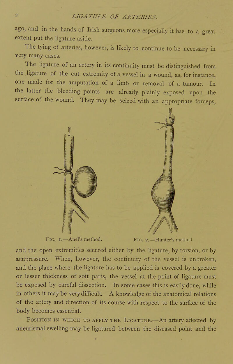 ago, and in the hands of Irish surgeons more especially it has to a great extent put the ligature aside. The tying of arteries, however, is likely to continue to be necessary in very many cases. The ligature of an artery in its continuity must be distinguished from the ligature of the cut extremity of a vessel in a wound, as, for instance, one made for the amputation of a limb or removal of a tumour. In the latter the bleeding points are already plainly exposed upon the surface of the wound. They may be seized with an appropriate forceps. Fig. I.—Anel's method. Fig. 2.—Hunter's method. and the open extremities secured either by the ligature, by torsion, or by acupressure. When, however, the continuity of the vessel is unbroken, and the place where the ligature has to be applied is covered by a greater or lesser thickness of soft parts, the vessel at the point of ligature must be exposed by careful dissection. In some cases this is easily done, while in others it maybe very difficult. A knowledge of the anatomical relations of the artery and direction of its course with respect to the surface of the body becomes essential. Position in which to apply the Ligature.—An artery affected by aneurismal swelHng may be ligatured between the diseased point and the