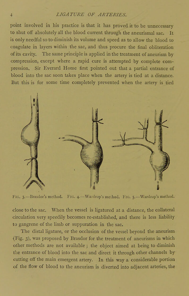 point involved in his practice is that it has proved it to be unnecessary to shut off absolutely all the blood current through the aneurismal sac. It is only needful so to diminish its volume and speed as to allow the blood to coagulate in layers within the sac, and thus procure the final obliteration of its cavity. The same principle is applied in the treatment of aneurism by compression, except where a rapid cure is attempted by complete com- pression. Sir Everard Home first pointed out that a partial entrance of blood into the sac soon takes place when the artery is tied at a distance. But this is for some time completely prevented when the artery is tied Fig. 3.—Brasdor's method. Fig. 4.—Waidrop's nielhod. FiG. 5.—Wardiop's method. close to the sac. When the vessel is ligatured at a distance, the collateral circulation very speedily becomes re-established, and there is less liability to gangrene of the limb or suppuration in the sac. The distal ligature, or the occlusion of the vessel beyond the aneurism (Fig. 3), was proposed by Brasdor for the treatment of aneurisms in which other methods are not available ; the object aimed at being to diminish the entrance of blood into the sac and direct it through other channels by cutting off the main emergent artery. In this way a considerable portion of the flow of blood to the aneurism is diverted into adjacent arteries, the