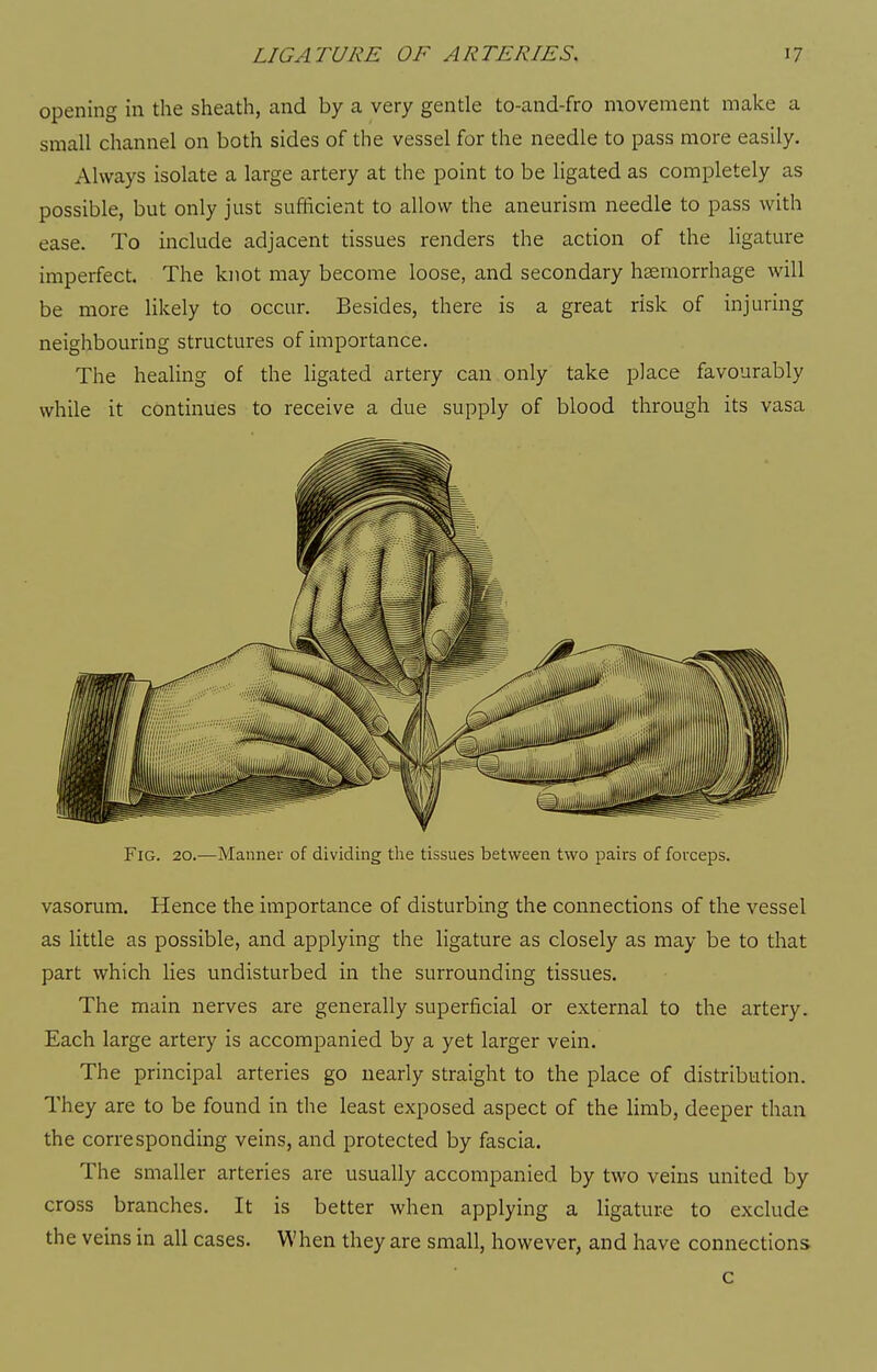 opening in the sheath, and by a very gentle to-and-fro movement make a small channel on both sides of the vessel for the needle to pass more easily. Always isolate a large artery at the point to be ligated as completely as possible, but only just sufficient to allow the aneurism needle to pass with ease. To include adjacent tissues renders the action of the Hgature imperfect. The knot may become loose, and secondary hsemorrhage will be more likely to occur. Besides, there is a great risk of injuring neighbouring structures of importance. The healing of the ligated artery can only take place favourably while it continues to receive a due supply of blood through its vasa Fig. 20.—Mannei- of dividing the tissues between two pairs of forceps. vasorum. Hence the importance of disturbing the connections of the vessel as little as possible, and applying the ligature as closely as may be to that part which lies undisturbed in the surrounding tissues. The main nerves are generally superficial or external to the artery. Each large artery is accompanied by a yet larger vein. The principal arteries go nearly straight to the place of distribution. They are to be found in the least exposed aspect of the limb, deeper than the corresponding veins, and protected by fascia. The smaller arteries are usually accompanied by two veins united by cross branches. It is better when applying a ligature to exclude the veins in all cases. When they are small, however, and have connections c