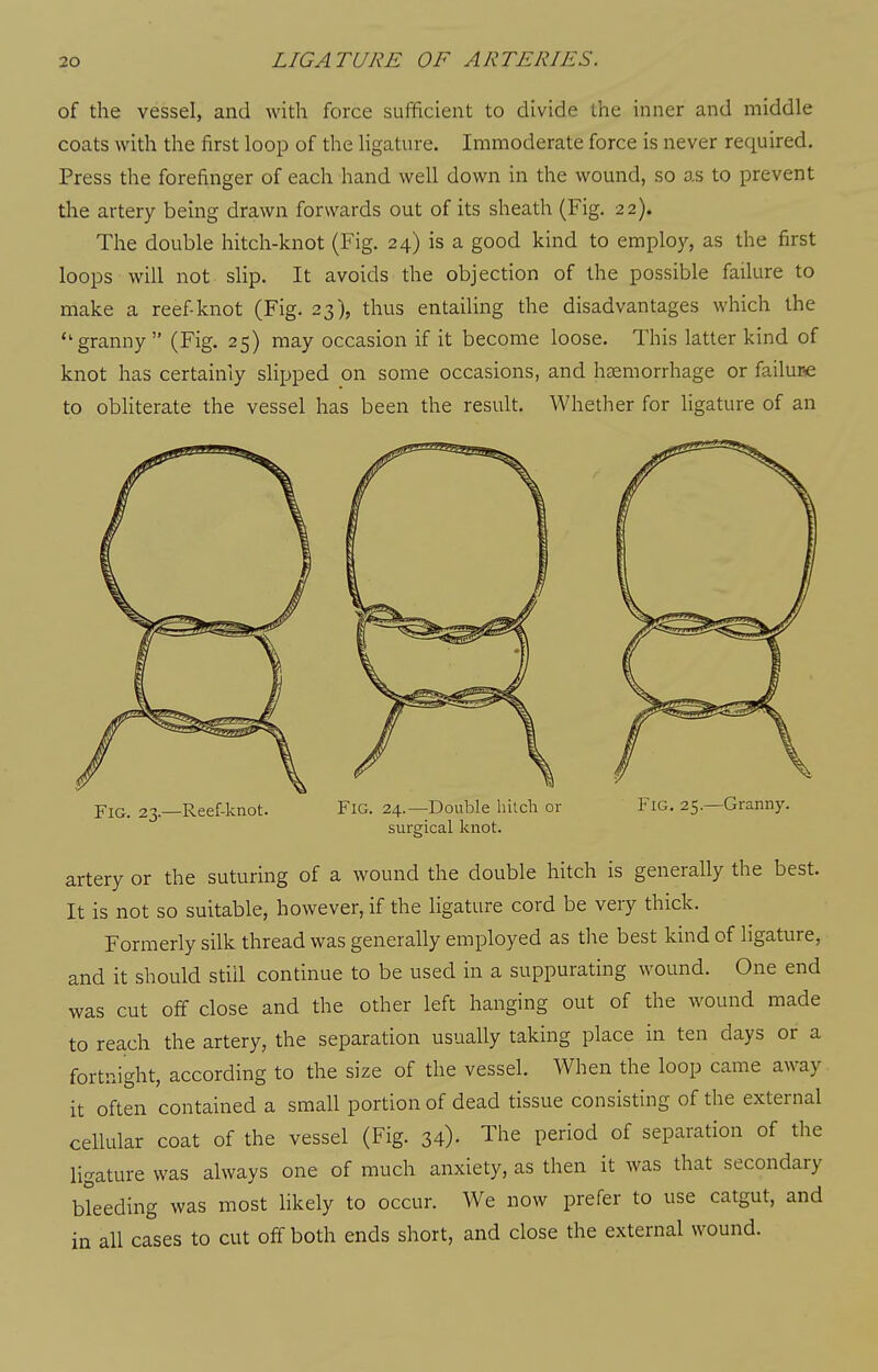 of the vessel, and with force sufficient to divide the inner and middle coats with the first loop of the ligature. Immoderate force is never required. Press the forefinger of each hand well down in the wound, so as to prevent the artery being drawn forwards out of its sheath (Fig. 22). The double hitch-knot (Fig. 24) is a good kind to employ, as the first loops will not sHp. It avoids the objection of the possible failure to make a reef-knot (Fig. 23), thus entailing the disadvantages which the granny  (Fig. 25) may occasion if it become loose. This latter kind of knot has certainly sHpped on some occasions, and haemorrhage or failune to obliterate the vessel has been the result. Whether for ligature of an Fig. 23.—Reef-knot. Fig. 24.—Double hitch or sureical knot. Fig. 25.—Granny. artery or the suturing of a wound the double hitch is generally the best. It is not so suitable, however, if the ligature cord be very thick. Formerly silk thread was generally employed as the best kind of ligature, and it should stiil continue to be used in a suppurating wound. One end was cut off close and the other left hanging out of the wound made to reach the artery, the separation usually taking place in ten days or a fortnight, according to the size of the vessel. When the loop came away it often contained a small portion of dead tissue consisting of the external cellular coat of the vessel (Fig. 34). The period of separation of the ligature was always one of much anxiety, as then it was that secondary bleeding was most likely to occur. We now prefer to use catgut, and in all cases to cut off both ends short, and close the external wound.