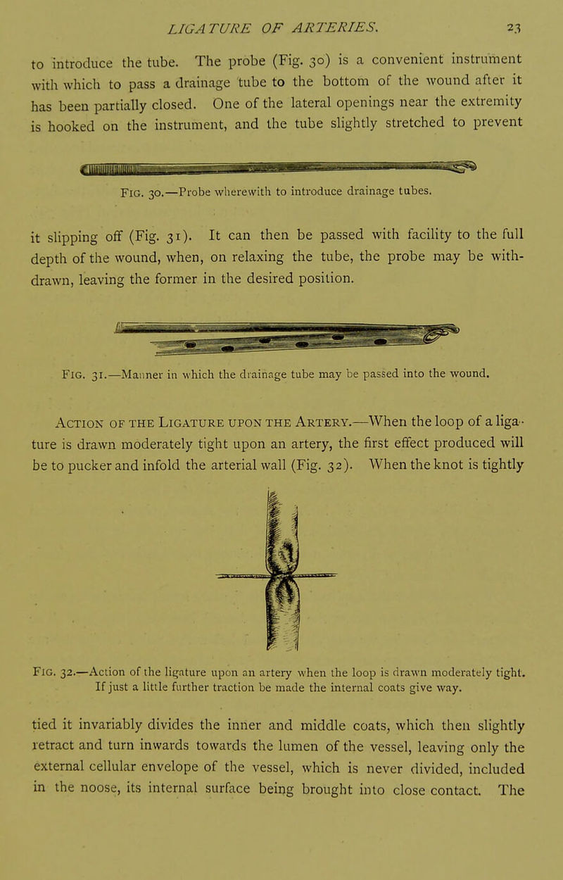 to introduce the tube. The probe (Fig. 30) is a convenient instrument with which to pass a drainage tube to the bottom of the wound after it has been partially closed. One of the lateral openings near the extremity is hooked on the instrument, and the tube slightly stretched to prevent Fig. 30.—Probe wherewith to introduce drainage tubes. it slipping off (Fig. 31). It can then be passed with faciHty to the full depth of the wound, when, on relaxing the tube, the probe may be with- drawn, leaving the former in the desired position. Fig. 31.—Manner in which the drainage tube may be passed into the wound. Action of the Ligature upon the Artery.—When the loop of a liga- ture is drawn moderately tight upon an artery, the first effect produced will be to pucker and infold the arterial wall (Fig. 32). When the knot is tightly Fig. 32.—Action of the liijature upon an artery when the loop is drawn moderately tight. If just a little further traction be made the internal coats give way. tied it invariably divides the inner and middle coats, which then slightly retract and turn inwards towards the lumen of the vessel, leaving only the external cellular envelope of the vessel, which is never divided, included in the noose, its internal surface being brought into close contact. The