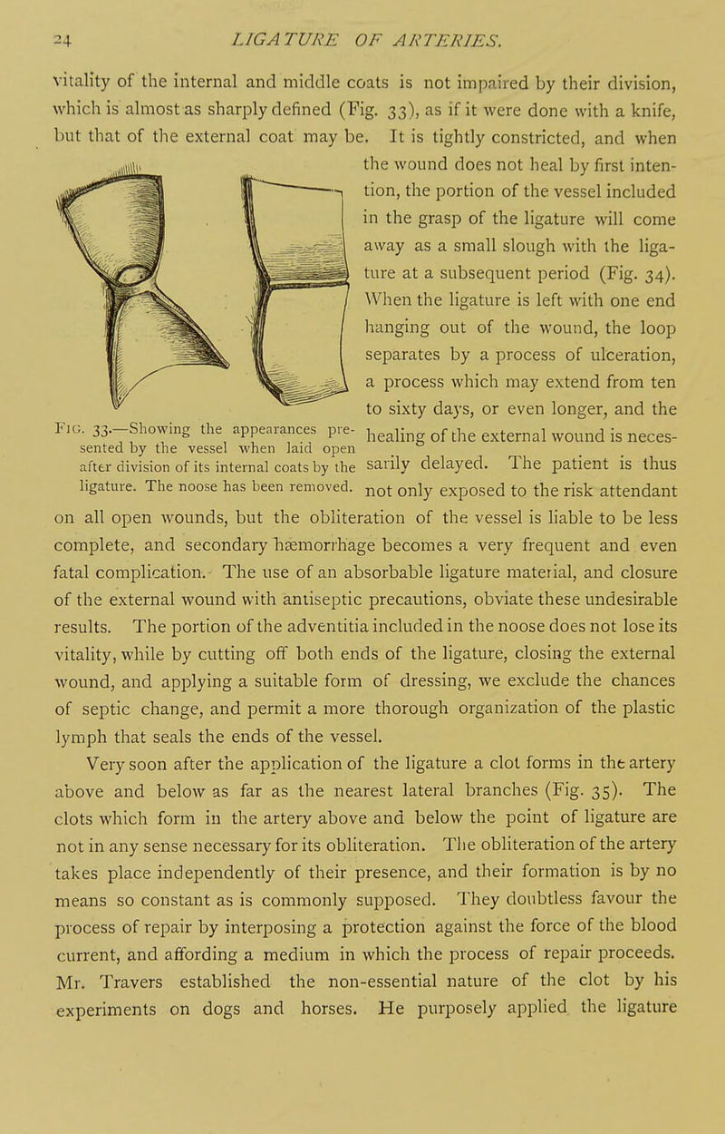 vitality of the internal and middle coats is not impaired by their division, which is almost as sharply defined (Fig. 33), as if it were done with a knife, but that of the external coat may be. It is tightly constricted, and when the wound does not heal by first inten- tion, the portion of the vessel included in the grasp of the ligature will come away as a small slough with the liga- ture at a subsequent period (Fig. 34). When the ligature is left with one end hanging out of tlie wound, the loop separates by a process of ulceration, a process which may extend from ten to sixty days, or even longer, and the FiG. 33.-Showing the appearances pre- healing of the external wound is neces- sented by the vessel when laid open after division of its internal coats by the sarily delayed. The patient is thus ligature. The noose has been removed, ^ot only exposed to the risk attendant on all open wounds, but the obliteration of the vessel is liable to be less complete, and secondaiy bKmorrhage becomes a very frequent and even fatal complication.- The use of an absorbable ligature material, and closure of the external wound with antiseptic precautions, obviate these undesirable results. The portion of the adventitia included in the noose does not lose its vitality, while by cutting off both ends of the ligature, closing the external wound, and applying a suitable form of dressing, we exclude the chances of septic change, and permit a more thorough organization of the plastic lymph that seals the ends of the vessel. Very soon after the application of the ligature a clot forms in the artery above and below as far as the nearest lateral branches (Fig. 35). The clots which form in the artery above and below the point of ligature are not in any sense necessary for its obliteration. The obliteration of the artery takes place independently of their presence, and their formation is by no means so constant as is commonly supposed. They doubtless favour the process of repair by interposing a protection against the force of the blood current, and affording a medium in which the process of repair proceeds. Mr. Travers established the non-essential nature of the clot by his experiments on dogs and horses. He purposely applied the ligature