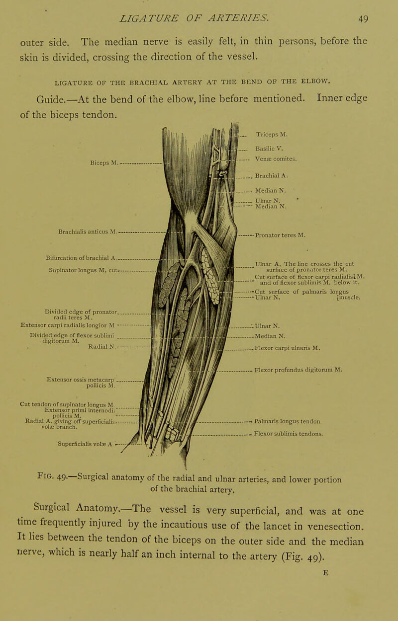 outer side. The median nerve is easily felt, in thin persons, before the skin is divided, crossing the direction of the vessel. LIGATURE OF THE BRACHIAL ARTERY AT THE BEND OF THE ELBOW. Guide.—At the bend of the elbow, line before mentioned. Inner edge of the biceps tendon. Biceps M. - Brachialis anticus M.— Bifurcation of brachial A.„, Supinator longus M. cut- «iiB»a»- ■ Hsiir Divided edge of pronator radii teres M. tji i Extensor carpi radialis longior M - \' ^fs/ltf Divided edge of flexor sublimi digitorum M. Radial N - Extensor ossis metacarp'... pollicis M. Cut tendon of supinator longus M Extensor primi intemodii pollicis M. — wmvMSBi i Radial A. giving off superficialis liii/iY 11 vote branch. Superficialis voice A Triceps M. Basilic V. - Venre comites. Brachial .4. -. Median N. Uhiar N. Median N. Pronator teres M. Ulnar A. The line crosses the cut surface of pronator teres M. Cut surface of flexor carpi radiahslM. and of flexor sublimis M. below it. Cut surface of palmaris longus Ulnar N. [muscle. Ulnar N. Median N. Flexor carpi ulnaris M. Flexor profundus digitorum M. Palmaris longus tendon Flexor sublimis tendons. Fig. 49.—Surgical anatomy of the radial and ulnar arteries, and lower portion of the brachial artery. Surgical Anatomy.—The vessel is very superficial, and was at one time frequently injured by the incautious use of the lancet in venesection. It lies between the tendon of the biceps on the outer side and the median nerve, which is nearly half an inch internal to the artery (Fig. 49).