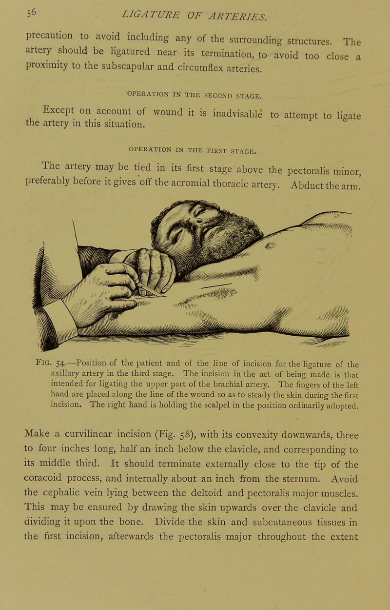 precaution to avoid including any of the surrounding structures. The artery should be ligatured near its termination, to avoid too close a proximity to the subscapular and circumflex arteries. OPERATION IN THE SECOND STAGE. Except on account of wound it is inadvisable to attempt to ligate the artery ni this situation. OPERATION IN THE FIRST STAGE. The artery may be tied in its first stage above the pectoralis minor, preferably before it gives 'off the acromial thoracic artery. Abduct the arm.' Fig. 54.—Position of the patient and of the line of incision for the ligature of the axillaiy artery in the third stage. The incision in the act of being made is tliat intended for ligating the upper part of the brachial artery. The fingers of the left hand are placed along the line of the wound so as to steady the skin during the first incision. The right hand is holding the scalpel in the position ordinarily adopted. Make a curvilinear incision (Fig. 58), with its convexity downwards, three to four inches long, half an inch below the clavicle, and corresponding to its middle third. It should terminate externally close to the tip of the coracoid process, and internally about an inch from the sternum. Avoid the cephaUc vein lying between the deltoid and pectoralis major muscles. This may be ensured by drawing the skin upwards over the clavicle and dividing it upon the bone. Divide the skin and subcutaneous tissues in the first incision, afterwards the pectoralis major throughout the extent