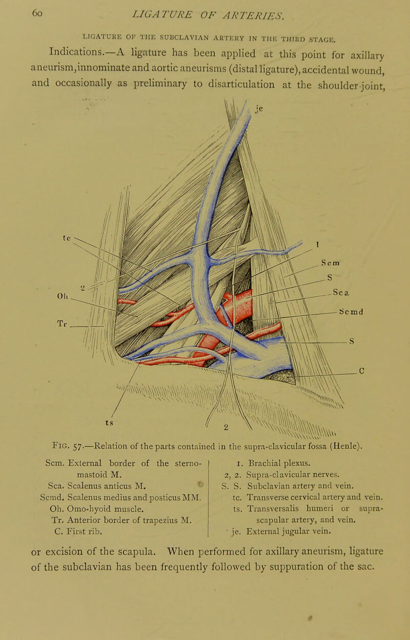 LIGATURE OF TllK SUBCLAVIAN ARTERY IN THE TIIIKD STAGE. Indications.—A ligature has been applied at this point for axillary aneurism,innominate and aortic aneurisms (distal ligature), accidental wound, and occasionally as preliminary to disarticulation at the shoulder-joint, Scmd Fig. 57.—Relation of the parts contained in the supra-clavicular fossa (Ilenle). Scm. External border of the sterno- mastoid M. Sea. Scalenus amicus M. ' Scmd. Scalenus medius and posticus MM. Oh. Omo-hyoid muscle. Tr. Anterior border of trapezius M. C. First rib. I. Brachial plexus. 2, 2. Supra-clavicular nerves. S. S. Subclavian artery and vein. tc. Transverse cervical artery and vein, ts. Transversalis humeri or supra- scapular artery, and vein. ■ je. External jugular vein. or excision of the scapula. When performed for axillary aneurism, ligature of the subclavian has been frequently followed by suppuration of the sac. *