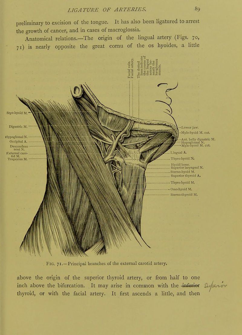 preliminary to excision of the tongue. It has also been ligatured to arrest the growth of cancer, and in cases of macroglossia. Anatomical relations.—The origin of the lingual artery (Figs. 70, 71) is nearly opposite the great cornu of the os hyoides, a little M. Fig. 71.—Principal brandies of the external carotid artery. above the origin of the superior thyroid artery, or from half to one inch above the bifurcation. It may arise in common with the inferior ^ii/^yfy thyroid, or with the facial artery. It first ascends a little, and then