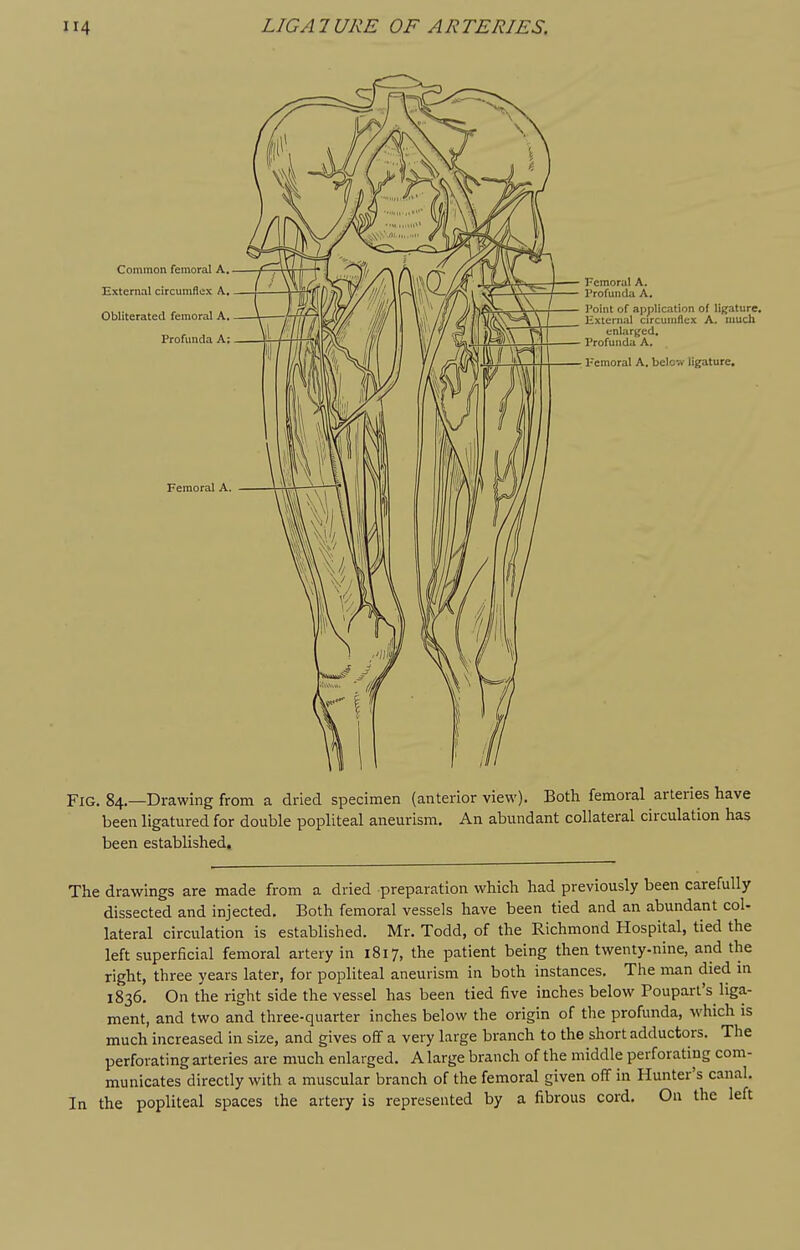 Common femoral A, External circumflex A, Obliterated femoral A. Profunda A; Femoral A. Femoral A. Profunda A, I'oint of application of ligature. Hxternal circumflex A. much enlarged. Profunda A. Femoral A. below ligature. Fig. 84,—Drawing from a dried specimen (anterior view). Both femoral arteries have been ligatured for double popliteal aneurism. An abundant collateral circulation has been established. The drawings are made from a dried preparation which had previously been carefully dissected and injected. Both femoral vessels have been tied and an abundant col- lateral circulation is established. Mr. Todd, of the Richmond Hospital, tied the left superficial femoral artery in 1817, the patient being then twenty-nine, and the right, three years later, for popliteal aneurism in both instances. The man died m 1836. On the right side the vessel has been tied five inches below Pouparl's liga- ment, and two and three-quarter inches below the origin of the profunda, which is much increased in size, and gives off a very large branch to the short adductors. The perforating arteries are much enlarged. A large branch of the middle perforating com- municates directly with a muscular branch of the femoral given off in Hunter's canal. In the popliteal spaces the artery is represented by a fibrous cord. On the left