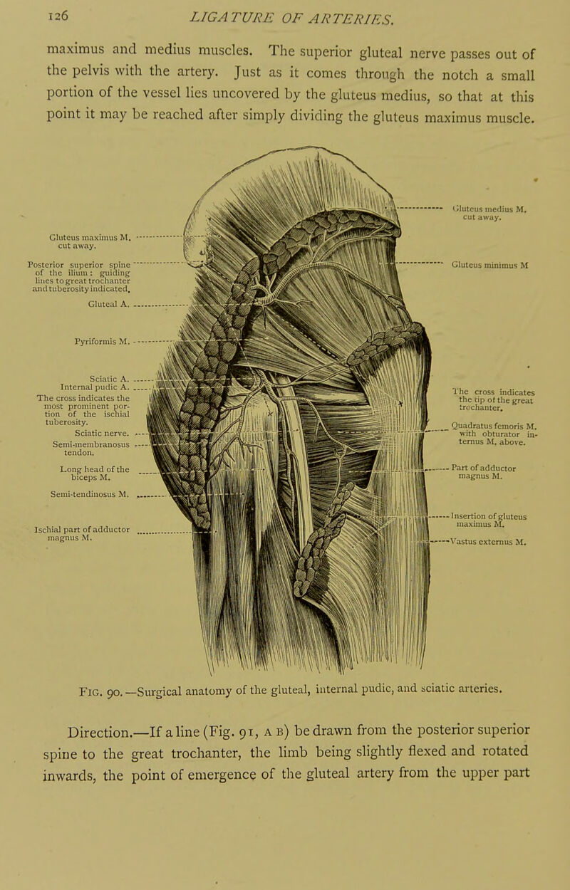 maximus and medius muscles. The superior gluteal nerve passes out of the pelvis with the artery. Just as it comes through the notch a small portion of the vessel lies uncovered by the gluteus medius, so that at this point it may be reached after simply dividing the gluteus maximus muscle. Gluteus maximus M. cut away. Posterior superior spine  of the ilium: guiding lines to great trochanter and tuberosity indicated. Gluteal A. - Pyriformis M. SciaUcA.-... 1,,,,., Internal pudic A , The cross indicates the >lnirli^ most prominent por- ' tion of the ischial tuberosity. Sciatic nerve. Semi-membranosus tendon. Long head of the biceps M. Semi-tendinosus M. Ischial part of adductor magnus M. • Gluteus medius M. cut away. Gluteus minimus M The cross indicates the tip of the great trochanter. Quadratus fcmoris M. with obturator in- terims M, above. Part of adductor magnus M. Insertion of gluteus maxunus M. ,——Vastus extemus M. Fig. 90, —Surgical anatomy of the gluteal, internal pudic, and sciatic arteries. Direction.—If aline (Fig. 91, a b) be drawn from the posterior superior spine to the great trochanter, the limb being slightly flexed and rotated inwards, the point of emergence of the gluteal artery from the upper part