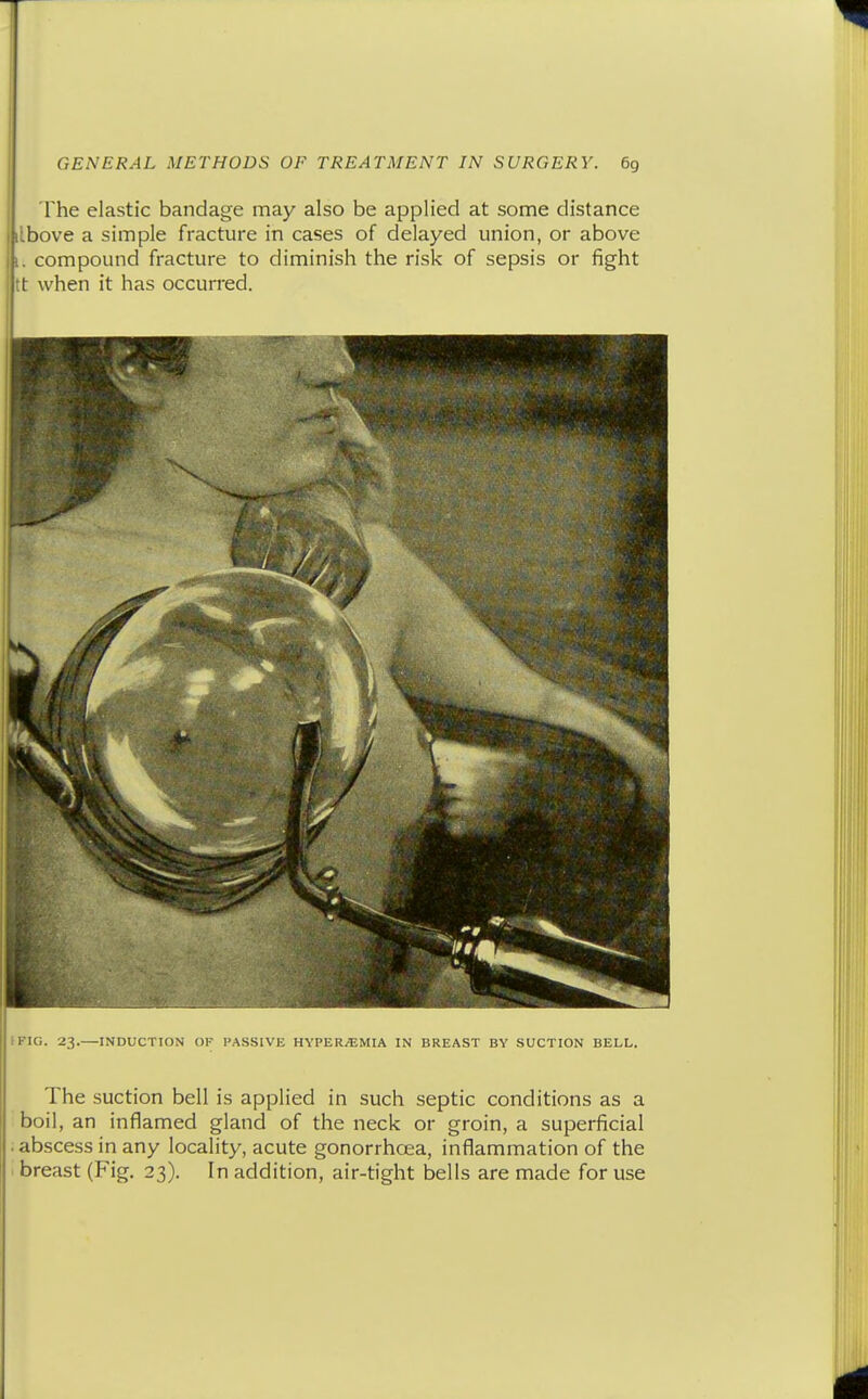 The elastic bandage may also be applied at some distance hove a simple fracture in cases of delayed union, or above compound fracture to diminish the risk of sepsis or fight I when it has occurred. I FIG. 23.—INDUCTION OK PASSIVE HYPERiEMIA IN BREAST BY SUCTION BELL. The suction bell is applied in such septic conditions as a boil, an inflamed gland of the neck or groin, a superficial ; abscess in any locality, acute gonorrhoea, inflammation of the breast (Fig. 23). In addition, air-tight bells are made for use