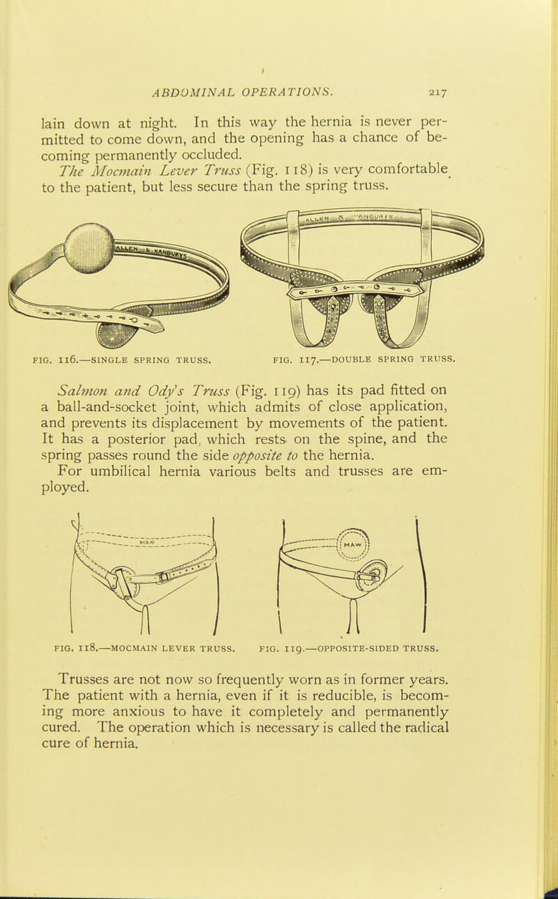 lain down at night. In this way the hernia is never per- mitted to come down, and the opening has a chance of be- coming permanently occluded. T/te jV/ocmam Lever Truss (Fig. 118) is very comfortable to the patient, but less secure than the spring truss. FIG. 116.—SINGLE SPRING TRUSS. FIG. IX7.—DOUBLE SPRING TRUSS. Salmon and Ody's Tncss (Fig. 119) has its pad fitted on a ball-and-socket joint, which admits of close application, and prevents its displacement by movements of the patient. It has a posterior pad, which rests on the spine, and the spring passes round the side opposite to the hernia. For umbilical hernia various belts and trusses are em- ployed. FIG. 118. MOCMAIN LEVER TRUSS. FIG. HQ. OPPOSITE-SIDED TRUSS. Trusses are not now so frequently worn as in former years. The patient with a hernia, even if it is reducible, is becom- ing more anxious to have it completely and permanently cured. The operation which is necessary is called the radical cure of hernia.