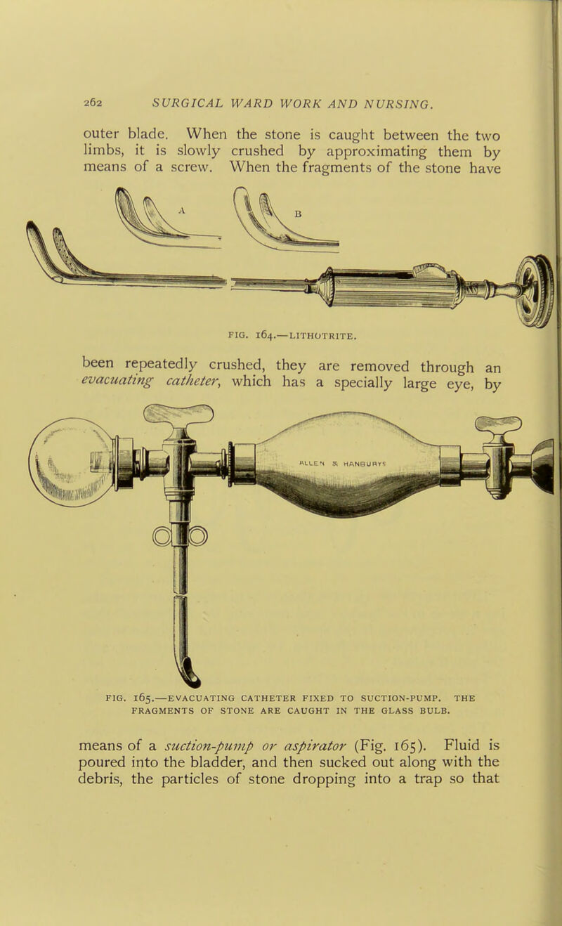 outer blade. When the stone is caught between the two limbs, it is slowly crushed by approximating them by means of a screw. When the fragments of the stone have FIG. 164.—LITHOTRITE. been repeatedly crushed, they are removed through an evacuating catheter, which has a specially large eye, by FIG. 165.—EVACUATING CATHETER FIXED TO SUCTION-PUMP. THE FRAGMENTS OF STONE ARE CAUGHT IN THE GLASS BULB. means of a suction-puvip or aspirator (Fig. 165). Fluid is poured into the bladder, and then sucked out along with the debris, the particles of stone dropping into a trap so that